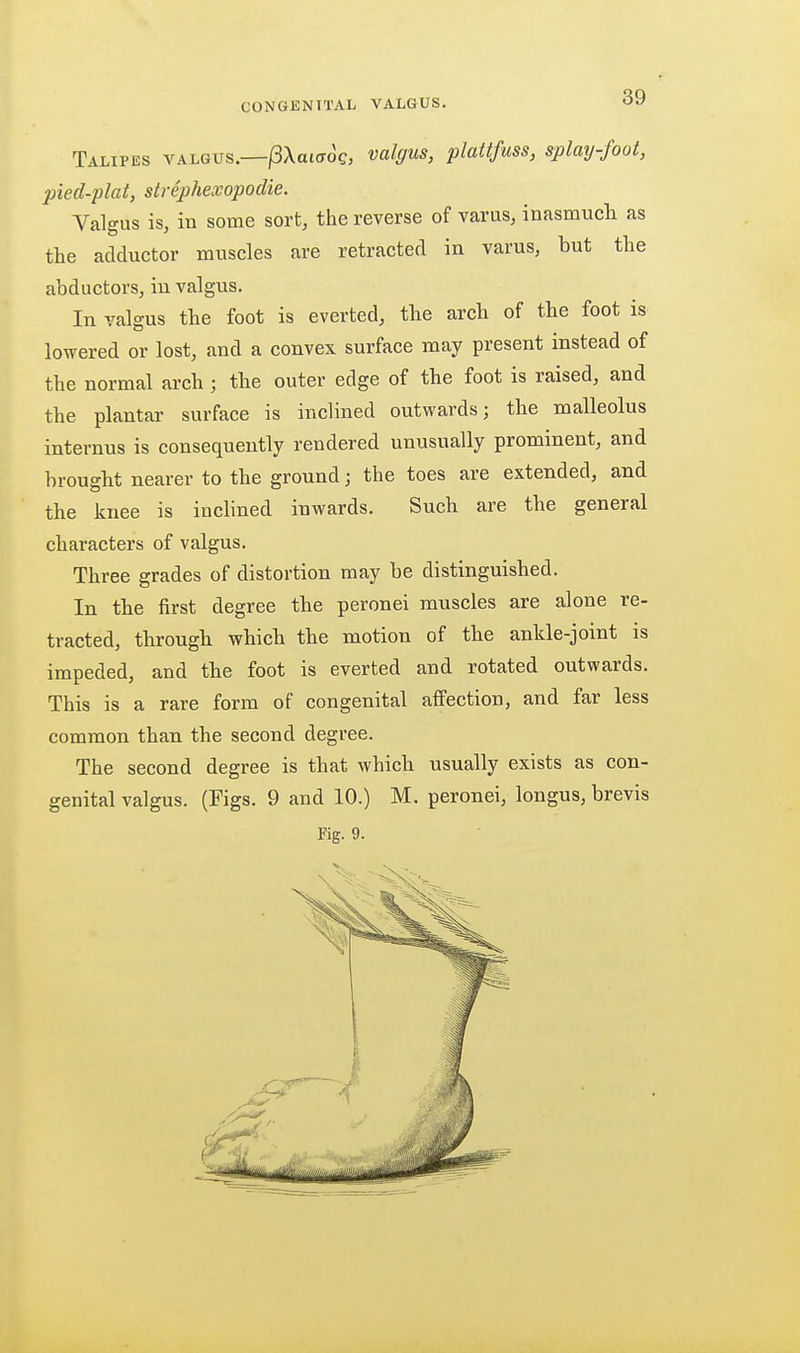 Talipes valgus.—j3Xai(rog, valgus, plattfuss, splay-foot, pied-plat, strephexopodie. Valgus is, in some sort, the reverse of varus, inasmuch as the adductor muscles are retracted in varus, but the abductors, in valgus. In valgus the foot is everted, the arch of the foot is lowered or lost, and a convex surface may present instead of the normal arch; the outer edge of the foot is raised, and the plantar surface is inclined outwards; the malleolus internus is consequently rendered unusually prominent, and brought nearer to the ground; the toes are extended, and the knee is inclined inwards. Such are the general characters of valgus. Three grades of distortion may be distinguished. In the first degree the peronei muscles are alone re- tracted, through which the motion of the ankle-joint is impeded, and the foot is everted and rotated outwards. This is a rare form of congenital affection, and far less common than the second degree. The second degree is that which usually exists as con- genital valgus. (Figs. 9 and 10.) M. peronei, longus, brevis Fig. 9.