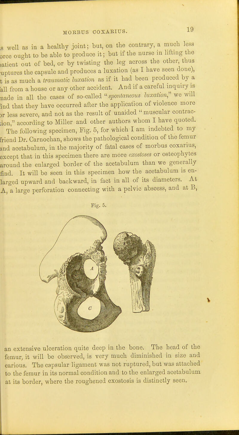 a well as in a healthy joint; but, on the contrary, a much less orce ought to be able to produce it; but if the nurse in lifting the mtient out of bed, or by twisting the leg across the other, thus ■uptures the capsule and produces a luxation (as I have seen done), t is as much a traumatic luxation as if it had been produced by a all from a house or any other accident. And if a careful inquiry is nade in all the cases of so-called  spontaneous luxation, we will ind that they have occurred after the application of violence more >r less severe, and not as the result of unaided muscular contrac- tion, according to Miller and other authors whom I have quoted. The following specimen, Fig. 5, for which I am indebted to my Friend Dr. Carnochan, shows the pathological condition of the femur and acetabulum, in the majority of fatal cases of morbus coxarius, except that in this specimen there are more exostoses or osteophytes around the enlarged border of the acetabulum than we generally find. It will be seen in this specimen how the acetabulum is en- larged upward and backward, in fact in all of its diameters. At A, a large perforation connecting with a pelvic abscess, and at B, Fig. 5. an extensive ulceration quite deep in the bone. The head of the femur; it will be observed, is very much diminished in size and carious. The capsular ligament was not ruptured, but was attached to the femur in its normal condition and to the enlarged acetabulum at its border, where the roughened exostosis is distinctly seen.
