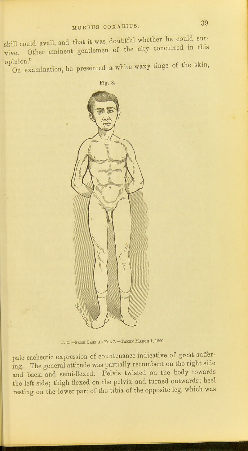 skill could avail, and that it was doubtful whether he could sur- vive. Other eminent gentlemen of the city concurred in this ^examination, he presented a white waxy tinge of the skin, J. C—Same Case as Fig. 7.—Taken March 1,1860. pale cachectic expression of countenance indicative of great suffer- ing. The general attitude was partially recumbent on the right side and back, and semi-flexed. Pelvis twisted on the body towards the left side; thigh flexed on the pelvis, and turned outwards; heel resting on the lower part of the tibia of the opposite leg, which was