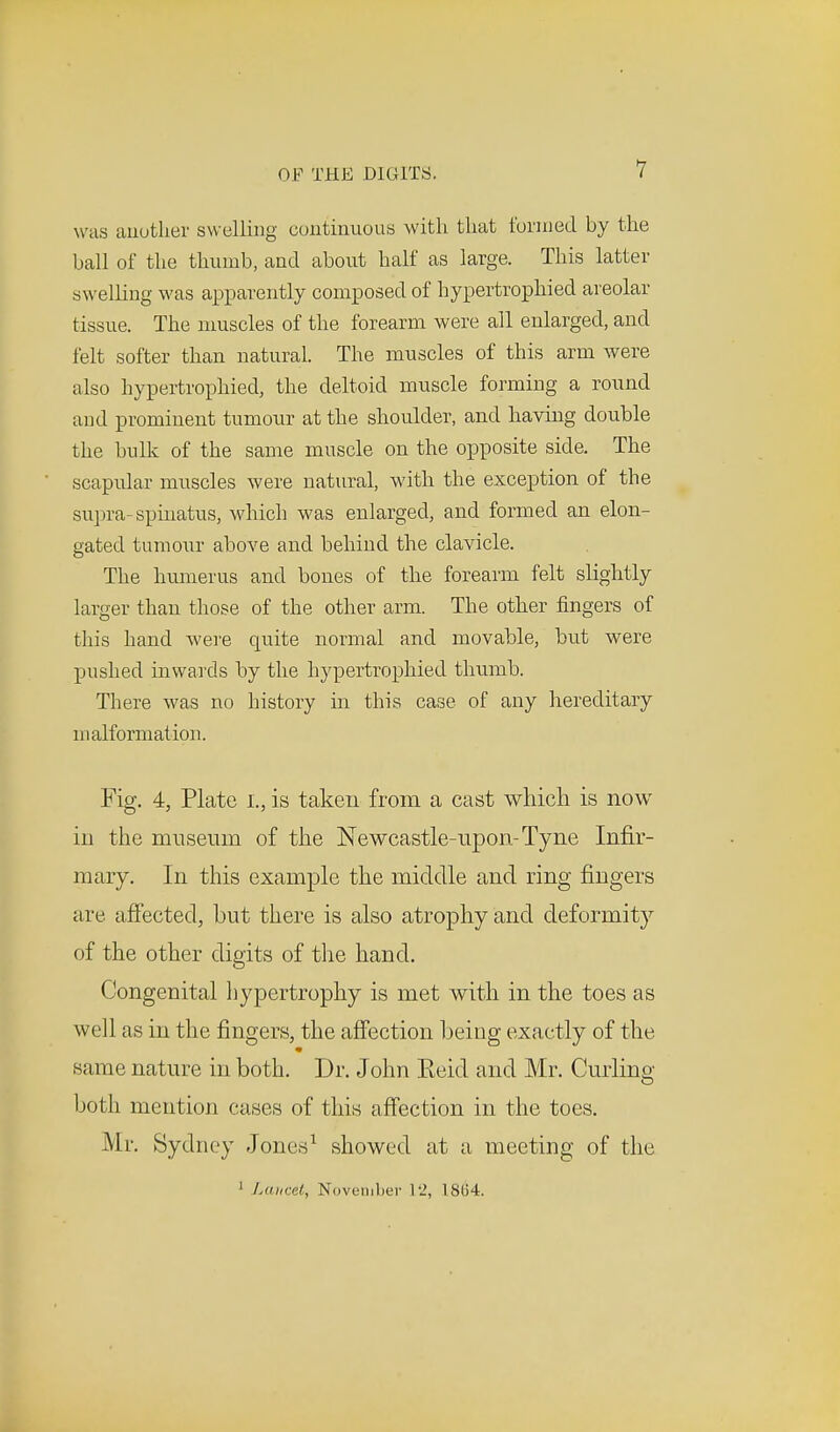 was another swelling continuous with that formed by the ball of the thumb, and about half as large. This latter swelling was apparently composed of hypertrophied areolar tissue. The muscles of the forearm were all enlarged, and felt softer than natural. The muscles of this arm were also hypertrophied, the deltoid muscle forming a round and prominent tumour at the shoulder, and having double the bulk of the same muscle on the opposite side. The scapular muscles were natural, with the exception of the supra-spinatus, which was enlarged, and formed an elon- gated tumour above and behind the clavicle. The humerus and bones of the forearm felt slightly larger than those of the other arm. The other fingers of this hand were quite normal and movable, but were pushed inwards by the hypertrophied thumb. There was no history in this case of any hereditary malformation. Fig. 4, Plate I., is taken from a cast which is now in the museum of the Newcastle-upon-Tyne Infir- mary. In this example the middle and ring fingers are affected, but there is also atrophy and deformity of the other digits of the hand. Congenital hypertrophy is met with in the toes as well as in the fingers, the affection being exactly of the same nature in both. Dr. John Eeid and Mr. Curling both mention cases of this affection in the toes. Mr. Sydney Jones1 showed at a meeting of the 1 Lancet, November 12, 18(14.
