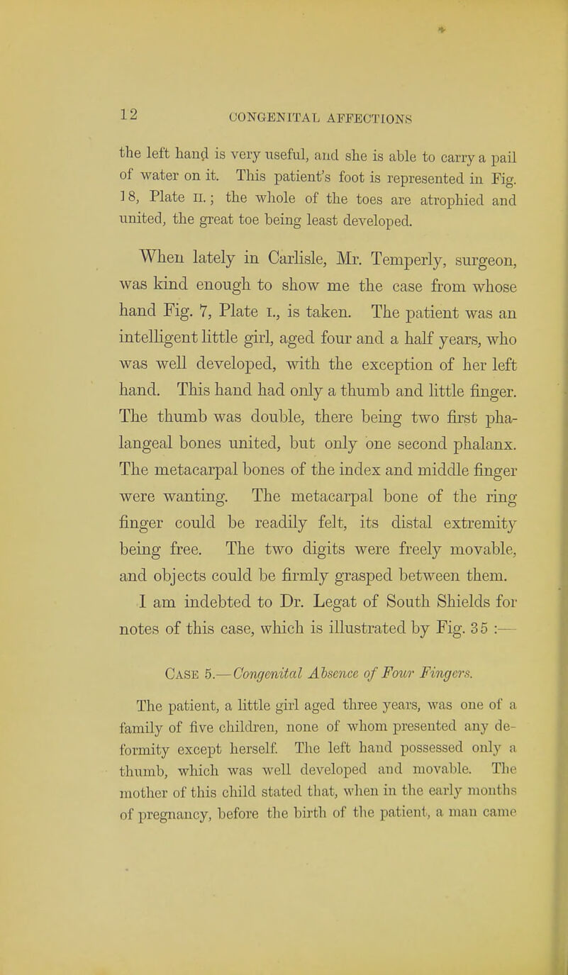 the left hand is very useful, find she is able to carry a pail of water on it. This patient's foot is represented in Fig. 18, Plate n.; the whole of the toes are atrophied and united, the great toe being least developed. When lately in Carlisle, Mr. Temperly, surgeon, was kind enough to show me the case from whose hand Fig. 7, Plate i., is taken. The patient was an intelligent little girl, aged four and a half years, who was well developed, with the exception of her left hand. This hand had only a thumb and little finger. The thumb was double, there being two first pha- langeal bones united, but only one second phalanx. The metacarpal bones of the index and middle finger were wanting. The metacarpal bone of the ring finger could be readily felt, its distal extremity being free. The two digits were freely movable, and objects could be firmly grasped between them. I am indebted to Dr. Legat of South Shields for notes of this case, which is illustrated by Fig. 35:— Case 5.—Congenital Absence of Four Fingers. The patient, a little girl aged three years, was one of a family of five children, none of whom presented any de- formity except herself. The left hand possessed only a thumb, which was well developed and movable. The mother of this child stated that, when in the early months of pregnancy, before the birth of the patient, a man came