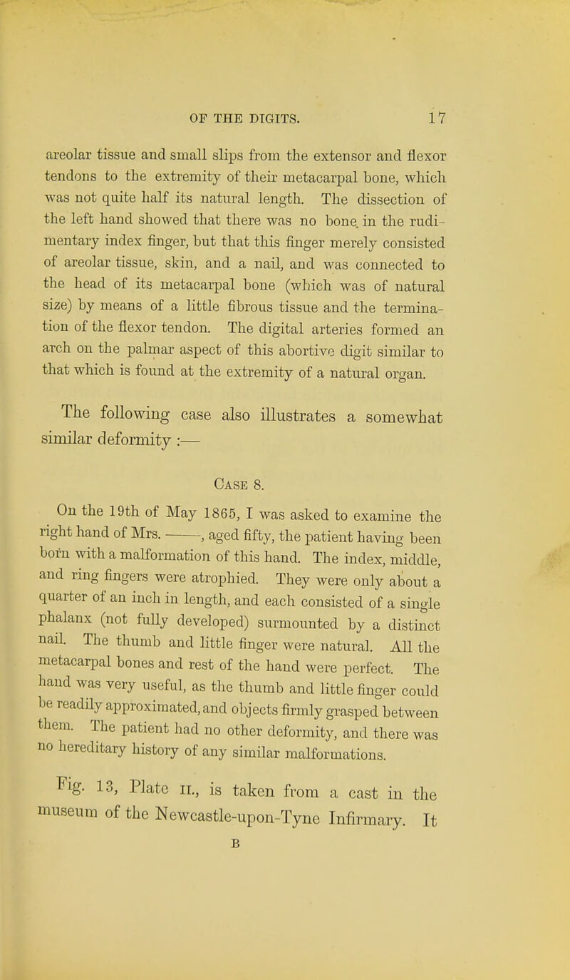 areolar tissue and small slips from the extensor and flexor tendons to the extremity of their metacarpal bone, which was not quite half its natural length. The dissection of the left hand showed that there was no bone, in the rudi- mentary index finger, but that this finger merely consisted of areolar tissue, skin, and a nail, and was connected to the head of its metacarpal bone (which was of natural size) by means of a little fibrous tissue and the termina- tion of the flexor tendon. The digital arteries formed an arch on the palmar aspect of this abortive digit similar to that which is found at the extremity of a natural organ. The following case also illustrates a somewhat siniilar deformity :— Case 8. On the 19th of May 1865, I was asked to examine the right hand of Mrs. , aged fifty, the patient having been born with a malformation of this hand. The index, middle, and ring fingers were atrophied. They were only about a quarter of an inch in length, and each consisted of a single phalanx (not fully developed) surmounted by a distinct nad. The thumb and little finger were natural. All the metacarpal bones and rest of the hand were perfect. The hand was very useful, as the thumb and little finger could be readily approximated, and objects firmly grasped between them. The patient had no other deformity, and there was no hereditary history of any similar malformations. Fig. 13, Plate il, is taken from a cast in the museum of the Newcastle-upon-Tyne Infirmary. It B