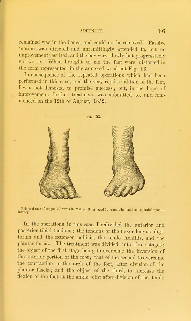 remained was in tlic bones, and conld not be removed. Passive motion was directed and imremittingly attended to, but no improvement resulted, and the boy very slowly but progressively got worse. When brought to me the feet were distorted in the form represented in the annexed wood-cut Fig, 93. In consequence of the repeated operations which had been performed in this case, and the very rigid condition of the feet, I was not disposed to promise success; but, in the hope of improvement, further treatment was submitted to, and com- menced on the 12th of August, 1852. FIG. 93. .^^elapsed case of congenital varus in Master H. A. aged 10 years, who had been operated upon in In the operations in this case, I redivided the anterior and posterior tibial tendons; the tendons of the flexor longus digi- torum and the extensor pollicis, the tendo Achillis, and the plantar fascia. The treatment was divided into three stages : the object of the first stage being to overcome the inversion of the anterior portion of the foot; that of the second to overcome the contraction in the arch of the foot, after division of the plantar fascia; and the object of the third, to increase the flexion of the foot at the ankle joint after division of the tendo