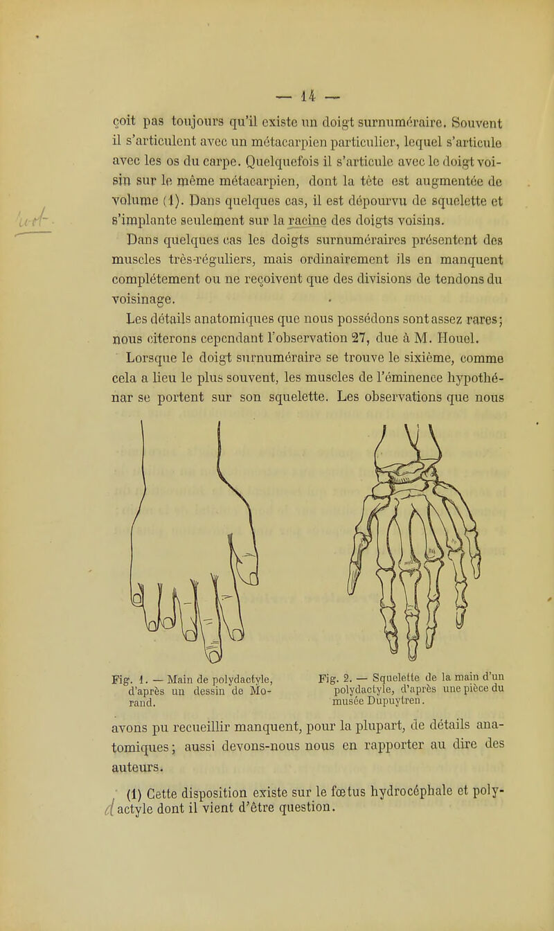 çoit pas toujours qu'il existe un doigt surnuméraire. Souvent il s'articulent avec un métacarpien particulier, lequel s'articule avec les os du carpe. Quelquefois il s'articule avec le doigt voi- sin sur le même métacarpien, dont la tète est augmentée de volume (1). Dans quelques cas, il est dépourvu de squelette et s'implante seulement sur la racine des doigts voisins. Dans quelques cas les doigts surnuméraires présentent des muscles très-réguliers, mais ordinairement ils en manquent complètement ou ne reçoivent que des divisions de tendons du voisinage. Les détails anatomiques que nous possédons sont assez rares; nous citerons cependant Tobservation 27, due à M. Houel. Lorsque le doigt surnuméraire se trouve le sixième, comme cela a lieu le plus souvent, les muscles de l'éminence liypothé- nar se portent sur son squelette. Les observations que nous Fig. 1. — Main de polydactyle, Fig. 2. — Squelette de la mam d un d'après un dessin de Mo- polydactyle, d'après une pièce du rand. musée Dupuylren. avons pu recueillir manquent, pour la plupart, de détails ana- tomiques; aussi devons-nous nous en rapporter au dire des auteurs. ■ (1) Cette disposition existe sur le fœtus hydrocéphale et poly- (jfactyle dont il vient d'être question.