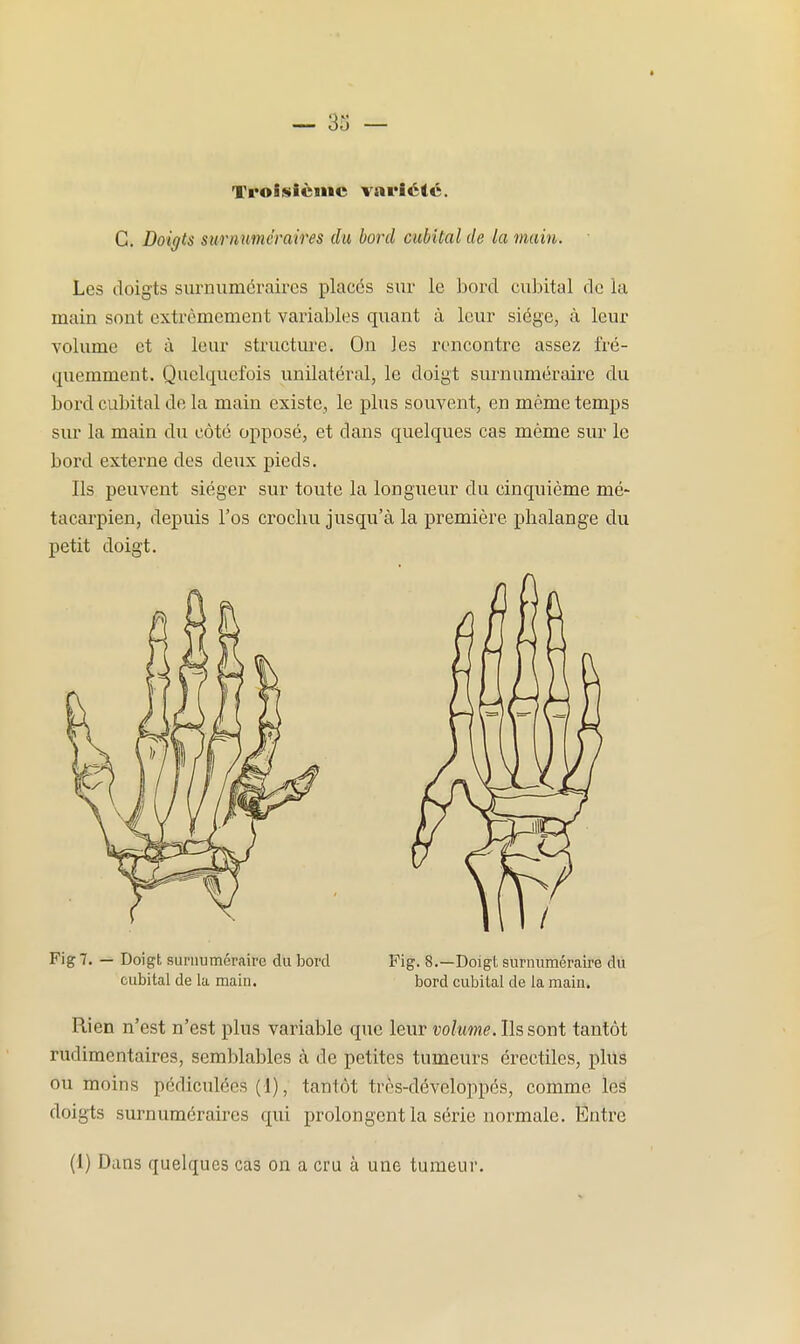 Troisième vai'icté. C. Doigts surnuméraires du bord cubital de la main. Les doigts sm^numcrakes places sur le bord cubital de la main sont extrêmement variables quant à leur siège, à leur volume et à leur structure. On les rencontre assez fré- quemment. Quelquefois unilatéral, le doigt surnuméraire du bord cubital de la main existe, le phis souvent, en même temps sur la main du côté opposé, et dans quelques cas même sur le bord externe des deux pieds. Ils peuvent siéger sur toute la longueur du cinquième mé- tacarpien, depuis l'os crochu jusqu'à la première phalange du petit doigt. Fig 7. — Doigt surnuméraire du bord Pig. 8.—Doigt surnuméraire dù cubital de la main. bord cubital de la main. Rien n'est n'est plus variable que leur volume. Ils sont tantôt rudimentaires, semblables à de petites tumeurs érectiles, plus ou moins pédiculées (1), tantôt trcs-développés, comme les doigts surnuméraires qui prolongent la série normale. Entre (1) Dans quelques cas on a cru à une tumeur.