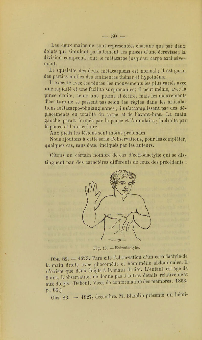 Les deux mains ne sont représentées chacune que par deux doigts qui simulent parfaitement les pinces d'une écrevisse; la division comprend tout |le métacarpe jusqu'au carpe exclusive- ment. Le squelette des deux métacarpiens est normal ; il est garni des parties molles des éminences thénar et hypothénar. Il exécute avec ces pinces les mouvements les plus variés avec une rapidité et une facilité surprenantes; il peut même, avec la pince droite, tenir une plume et écrire, mais les mouvements d'écriture ne se passent pas selon les règles dans les articula- tions métacarpo-phalangiennes ; ils s'accomplissent par des dé- placements en totalité du carpe et de l'avant-bras. La main gauche paraît formée par le pouce et l'annulaire ; la droite par le pouce et l'auriculaire. Aux pieds les lésions sont moins profondes. Nous ajoutons à cette série d'observations, pour les compléter, quelques cas, sans date, indiqués par les auteurs. Citons un certain nombre de cas d'ectrodactylie qui se dis- tinguent par des caractères différents de ceux des précédents : Fig. 10. — Ectrodactylie. Obs. 82. — 1573. Paré cite l'observation d'un ectrodactyle de la main droite avec phocomôlie et hémimélie abdominales. Il n'existe que deux doigts à la main droite. L'enfant est âge de 9 ans. L'observation ne donne pas d'autres détails relativement aux doigts. (Debout, Vices de conformation des membres. 186d, p. 86.) Obs. 83. — 1827, décembre. M. Blandin présente un hémi-