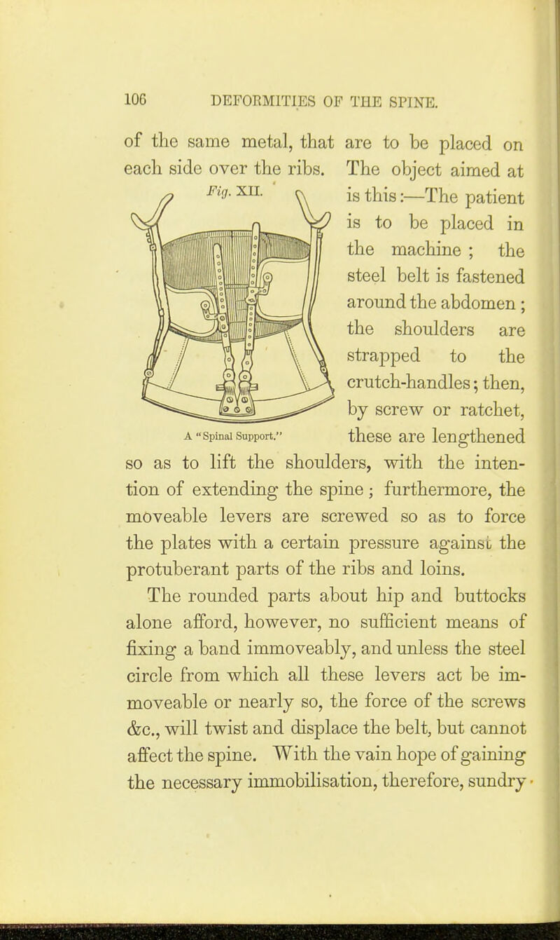 of the same metal, that are to be placed on each side over the ribs. The object aimed at is this:—The patient is to be placed in the machine ; the steel belt is fastened around the abdomen; the shoulders are strapped to the crutch-handles; then, by screw or ratchet, A Spinal Support. thcse arc lengthened so as to lift the shoulders, with the inten- tion of extending the spine ; furthermore, the moveable levers are screwed so as to force the plates with a certain pressure against the protuberant parts of the ribs and loins. The rounded parts about hip and buttocks alone afford, however, no sufficient means of fixing a band immoveably, and unless the steel circle from which all these levers act be im- moveable or nearly so, the force of the screws &c., will twist and displace the belt, but cannot affect the spine. With the vain hope of gaining the necessary immobilisation, therefore, sundry ■