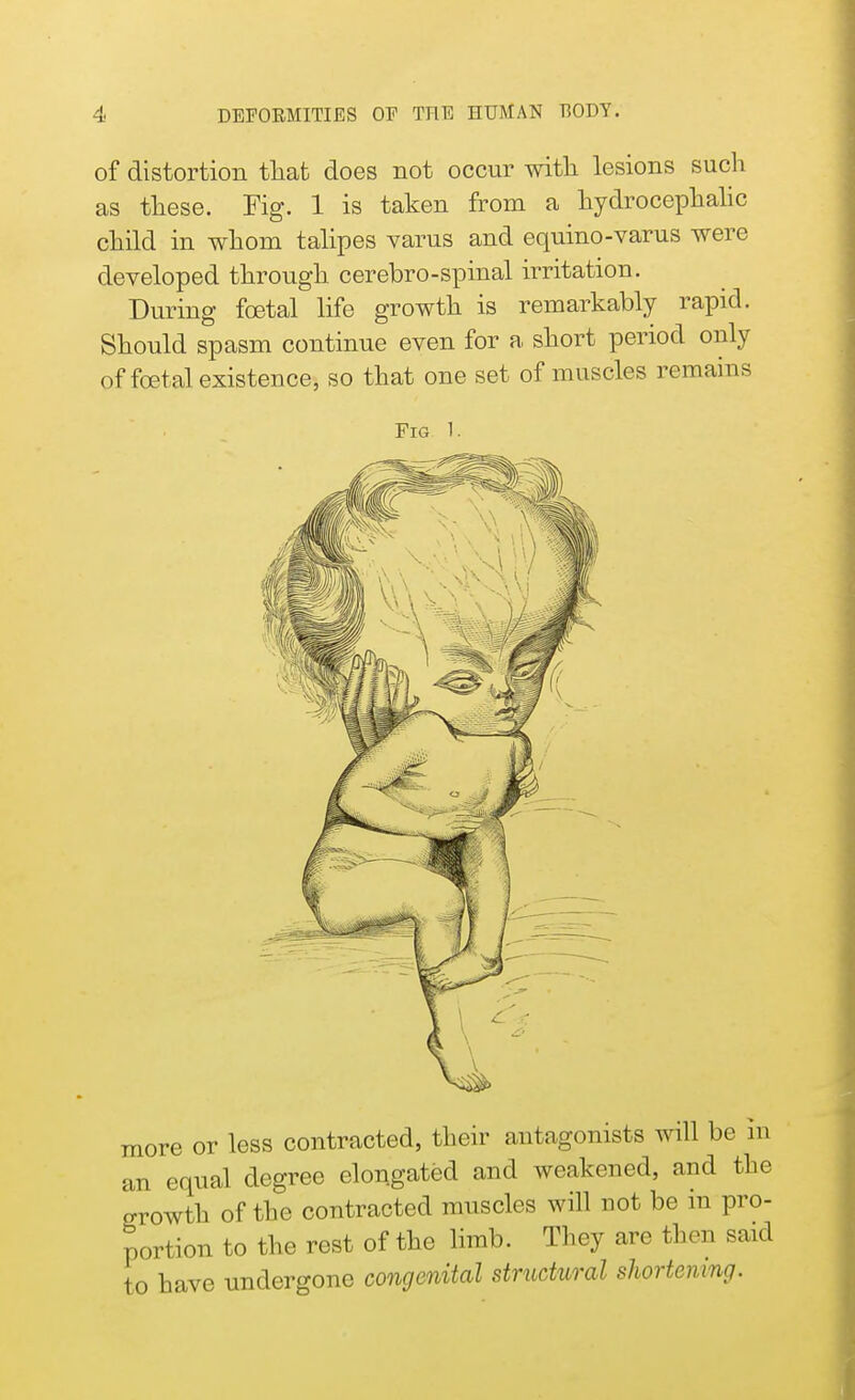 of distortion that does not occur with lesions such as these. Fig. 1 is taken from a hydrocephalic child in whom talipes varus and equino-varus were developed through cerebro-spinal irritation. During foetal life growth is remarkably rapid. Should spasm continue even for a short period only of fetal existence, so that one set of muscles remains Fig 1. more or less contracted, their antagonists will be In an equal degree elongated and weakened, and the growth of the contracted muscles will not be in pro- portion to the rest of the limb. They are then said to have undergone congenital structural shortening.