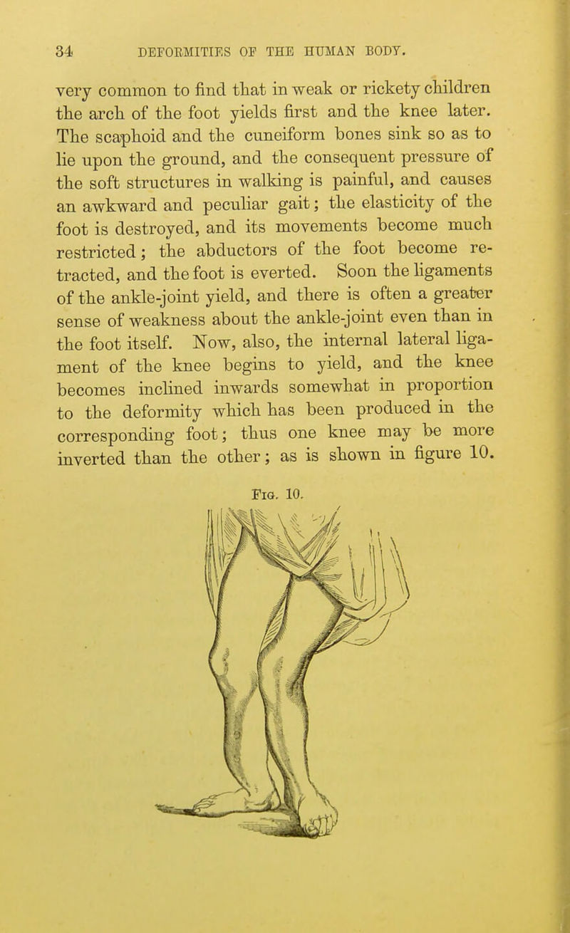 very common to find that in weak or rickety children the arch of the foot yields first and the knee later. The scaphoid and the cuneiform bones sink so as to lie upon the ground, and the consequent pressure of the soft structures in walking is painful, and causes an awkward and peculiar gait; the elasticity of the foot is destroyed, and its movements become much restricted; the abductors of the foot become re- tracted, and the foot is everted. Soon the ligaments of the ankle-joint yield, and there is often a greater sense of weakness about the ankle-joint even than in the foot itself. Now, also, the internal lateral liga- ment of the knee begins to yield, and the knee becomes inclined inwards somewhat in proportion to the deformity which has been produced in the corresponding foot; thus one knee may be more inverted than the other; as is shown in figure 10. Fig. 10.