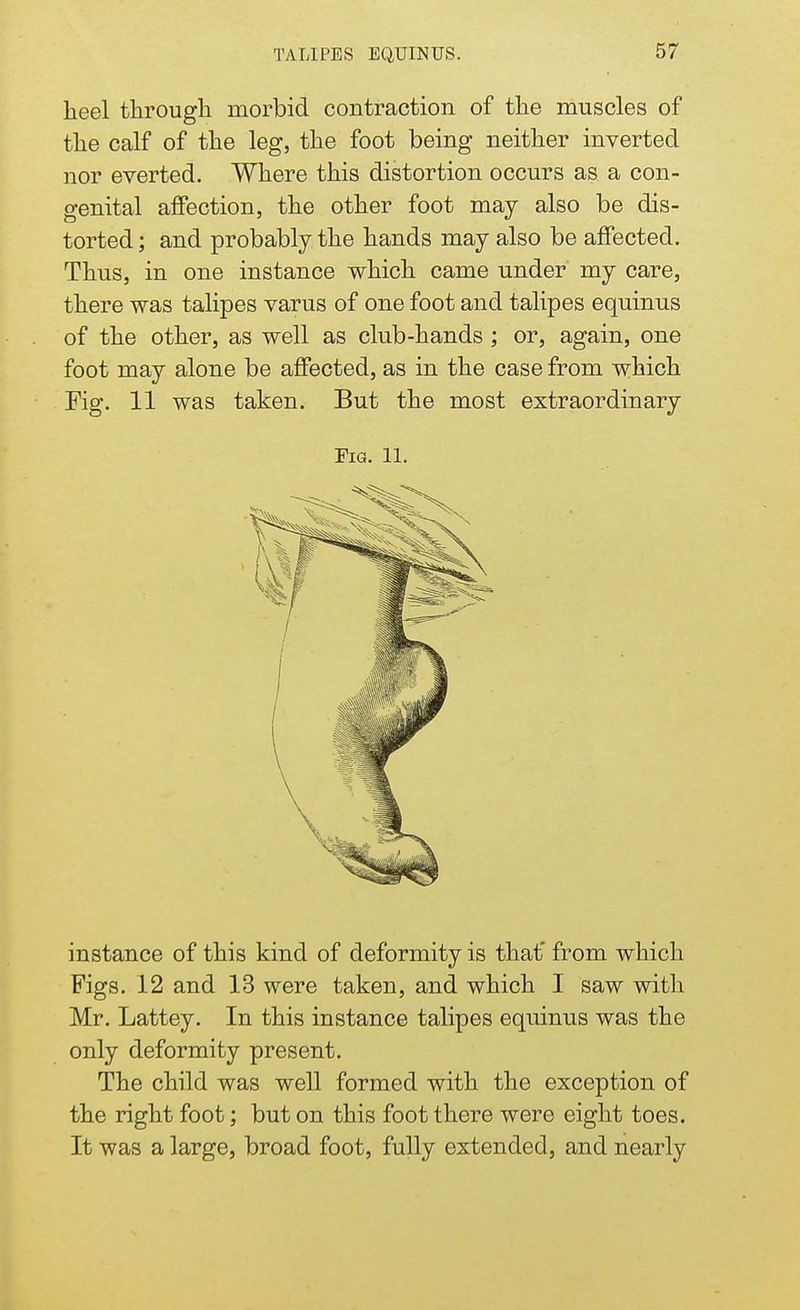 heel through morbid contraction of the muscles of the calf of the leg, the foot being neither inverted nor everted. Where this distortion occurs as a con- genital affection, the other foot may also be dis- torted ; and probably the hands may also be affected. Thus, in one instance which came under my care, there was talipes varus of one foot and talipes equinus of the other, as well as club-hands ; or, again, one foot may alone be affected, as in the case from which Fig. 11 was taken. But the most extraordinary Fig. 11. instance of this kind of deformity is that' from which Figs. 12 and 13 were taken, and which I saw with Mr. Lattey. In this instance talipes equinus was the only deformity present. The child was well formed with the exception of the right foot; but on this foot there were eight toes. It was a large, broad foot, fully extended, and nearly
