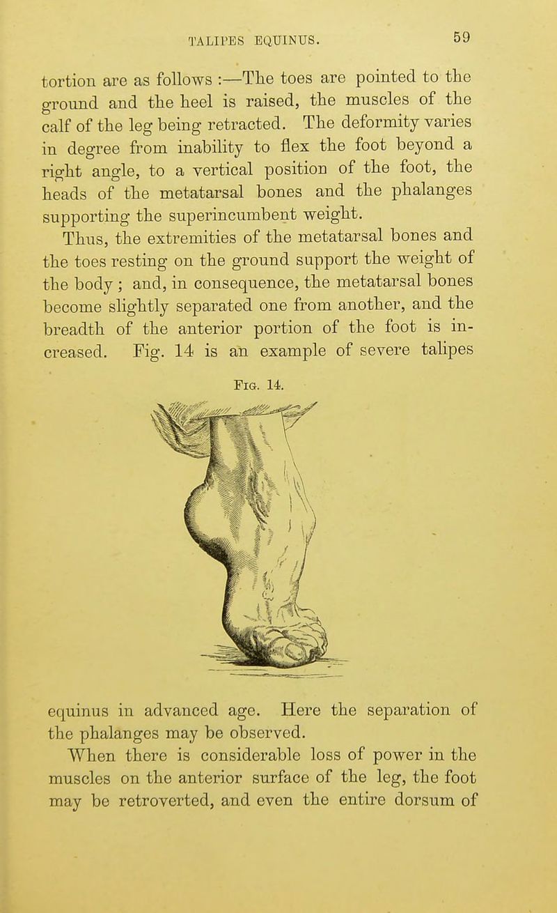 tortion are as follows :—The toes are pointed to the ground and the heel is raised, the muscles of the calf of the leg being retracted. The deformity varies in degree from inability to flex the foot beyond a right angle, to a vertical position of the foot, the heads of the metatarsal bones and the phalanges supporting the superincumbent weight. Thus, the extremities of the metatarsal bones and the toes resting on the ground support the weight of the body; and, in consequence, the metatarsal bones become slightly separated one from another, and the breadth of the anterior portion of the foot is in- creased. Fig. 14 is an example of severe talipes Fig. 14. equinus in advanced age. Here the separation of the phalanges may be observed. When there is considerable loss of power in the muscles on the anterior surface of the leg, the foot may be retroverted, and even the entire dorsum of
