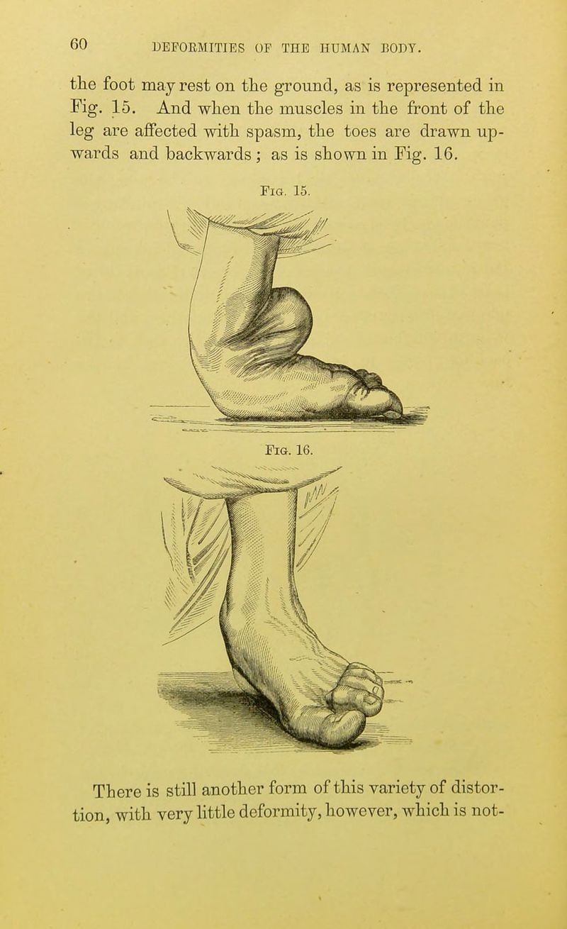 the foot may rest on the ground, as is represented in Fig. 15. And when the muscles in the front of the leg are affected with spasm, the toes are drawn up- wards and backwards ; as is shown in Fig. 16. Fig. 15. There is still another form of this variety of distor- tion, with very little deformity, however, which is not-