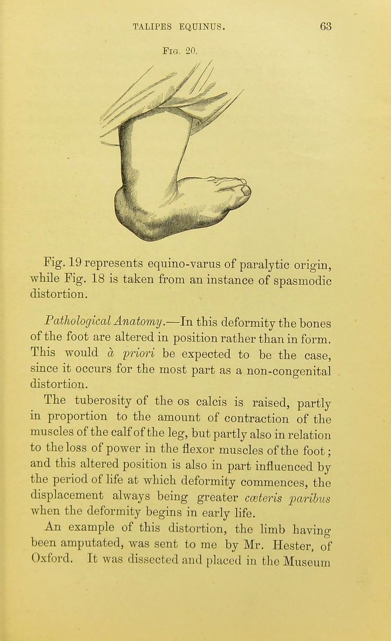 Pig. 20. Fig. 19 represents equino-varus of paralytic origin, while Fig. 18 is taken from an instance of spasmodic distortion. Pathological Anatomy.—In this deformity the bones of the foot are altered in position rather than in form. This would a priori be expected to be the case, since it occurs for the most part as a non-congenital distortion. The tuberosity of the os calcis is raised, partly in proportion to the amount of contraction of the muscles of the calf of the leg, but partly also in relation to the loss of power in the flexor muscles of the foot; and this altered position is also in part influenced by the period of life at which deformity commences, the displacement always being greater cceteris paribus when the deformity begins in early life. An example of this distortion, the limb having been amputated, was sent to me by Mr. Hester, of Oxford. It was dissected and placed in the Museum