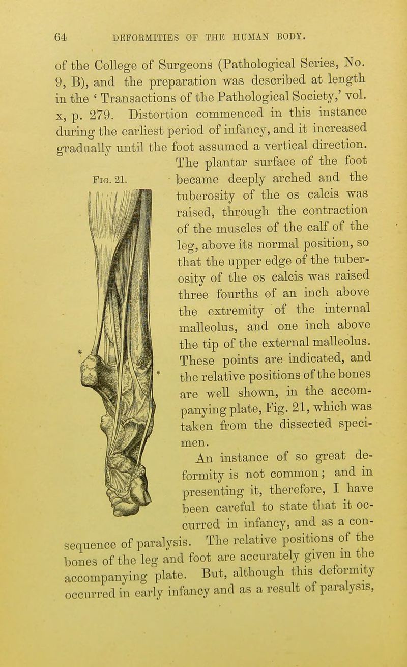 Fig. 21. of the College of Surgeons (Pathological Series, No. 9, B), and the preparation was described at length in the ' Transactions of the Pathological Society,' vol. x, p. 279. Distortion commenced in this instance during the earliest period of infancy, and it increased gradually until the foot assumed a vertical direction. The plantar surface of the foot became deeply arched and the tuberosity of the os calcis was raised, through the contraction of the muscles of the calf of the leg, above its normal position, so that the upper edge of the tuber- osity of the os calcis was raised three fourths of an inch above the extremity of the internal malleolus, and one inch above the tip of the external malleolus. These points are indicated, and the relative positions of the bones are well shown, in the accom- panying plate, Fig. 21, which was taken from the dissected speci- men. An instance of so great de- formity is not common; and in presenting it, therefore, I have been careful to state that it oc- curred in infancy, and as a con- sequence of paralysis. The relative positions of the bones of the leg and foot are accurately given m the accompanying plate. But, although this deformity occurred in early infancy and as a result of paralysis,