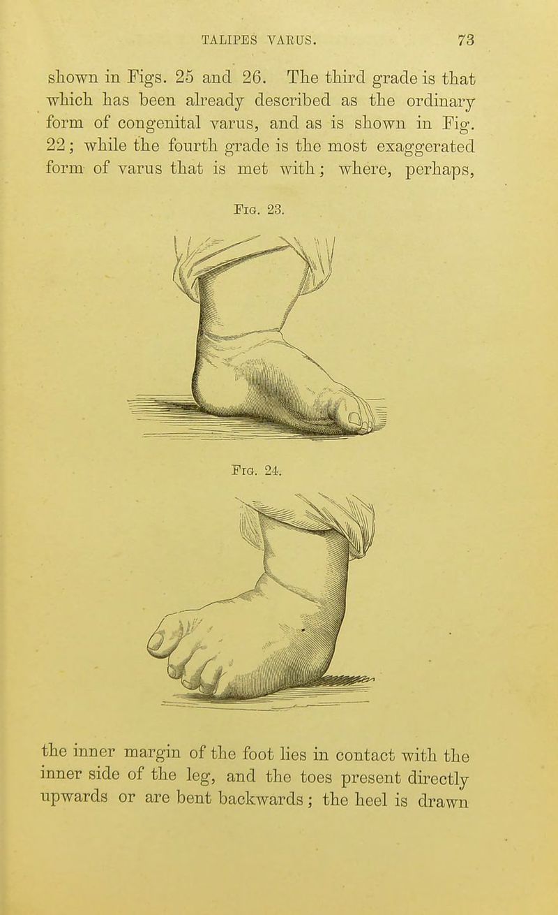 shown in Figs. 25 and 26. The third grade is that which has been already described as the ordinary form of congenital varus, and as is shown in Fig. 22; while the fourth grade is the most exaggerated form of varus that is met with ; where, perhaps, Fig. 23. the inner margin of the foot lies in contact with the inner side of the leg, and the toes present directly upwards or are bent backwards; the heel is drawn