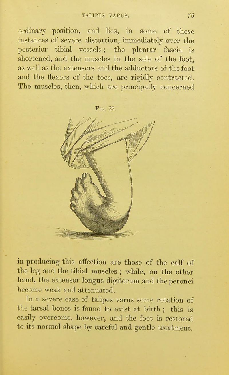 ordinary position, and lies, in some of these instances of severe distortion, immediately over the posterior tibial vessels; the plantar fascia is shortened, and the mnscles in the sole of the foot, as well as the extensors and the adductors of the foot and the flexors of the toes, are rigidly contracted. The muscles, then, which are principally concerned Fig. 27. in producing this affection are those of the calf of the leg and the tibial muscles ; while, on the other hand, the extensor longus digitorum and theperonei become weak and attenuated. In a severe case of talipes varus some rotation of the tarsal bones is found to exist at birth; this is easily overcome, however, and the foot is restored to its normal shape by careful and gentle treatment.