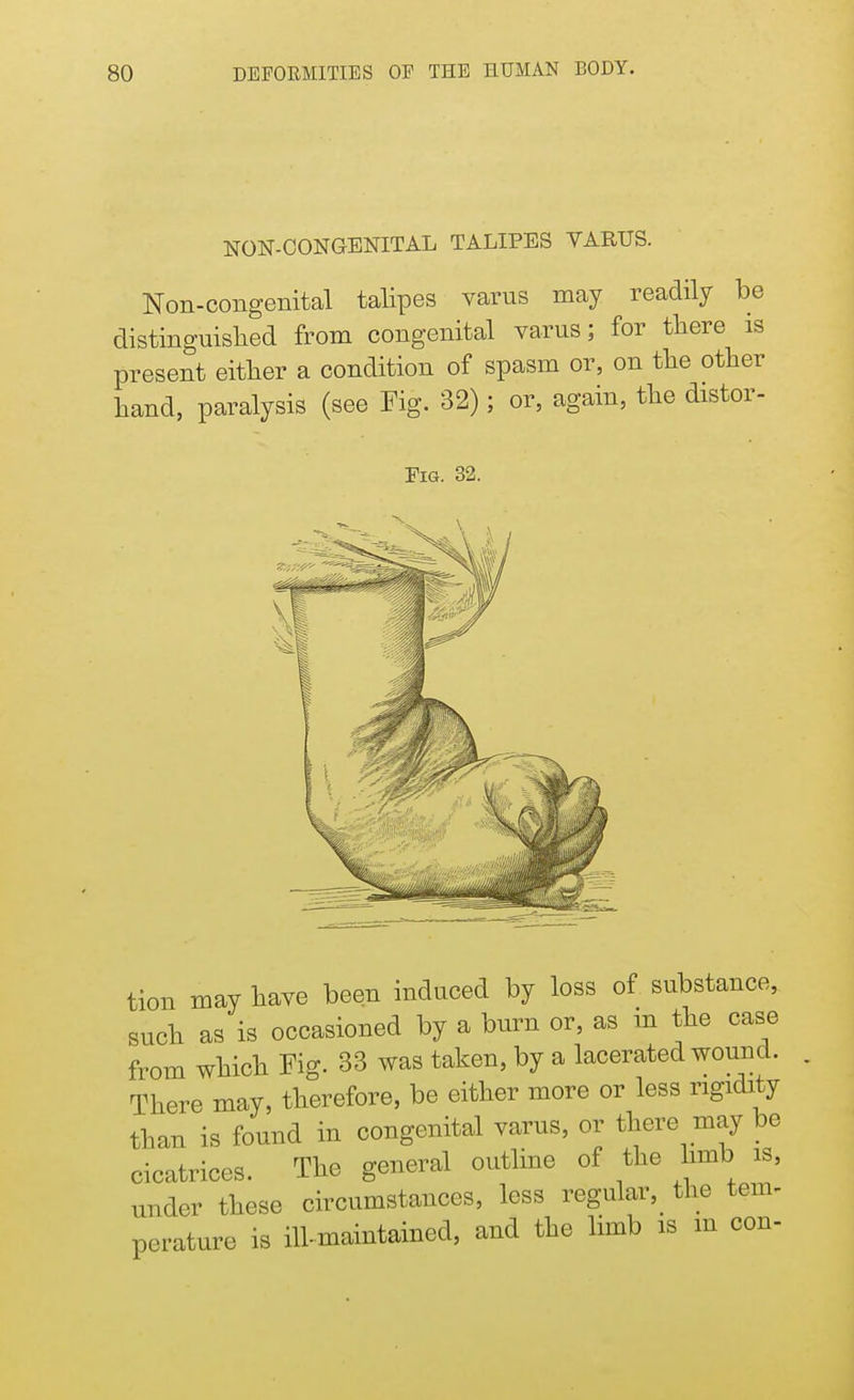 NON-CONGENITAL TALIPES VARUS. Non-congenital talipes varus may readily be distinguished from congenital varus; for there is present either a condition of spasm or, on the other hand, paralysis (see Fig. 32); or, again, the distor- Eig. 32. tion may have been induced by loss of substance, such as is occasioned by a burn or, as m the case from which Fig. 33 was taken, by a lacerated wound. There may, therefore, be either more or less rigidity than is found in congenital varus, or there may be cicatrices. The general outline of the limb is, under these circumstances, less regular, the tem- perature is ill-maintained, and the limb is in con-