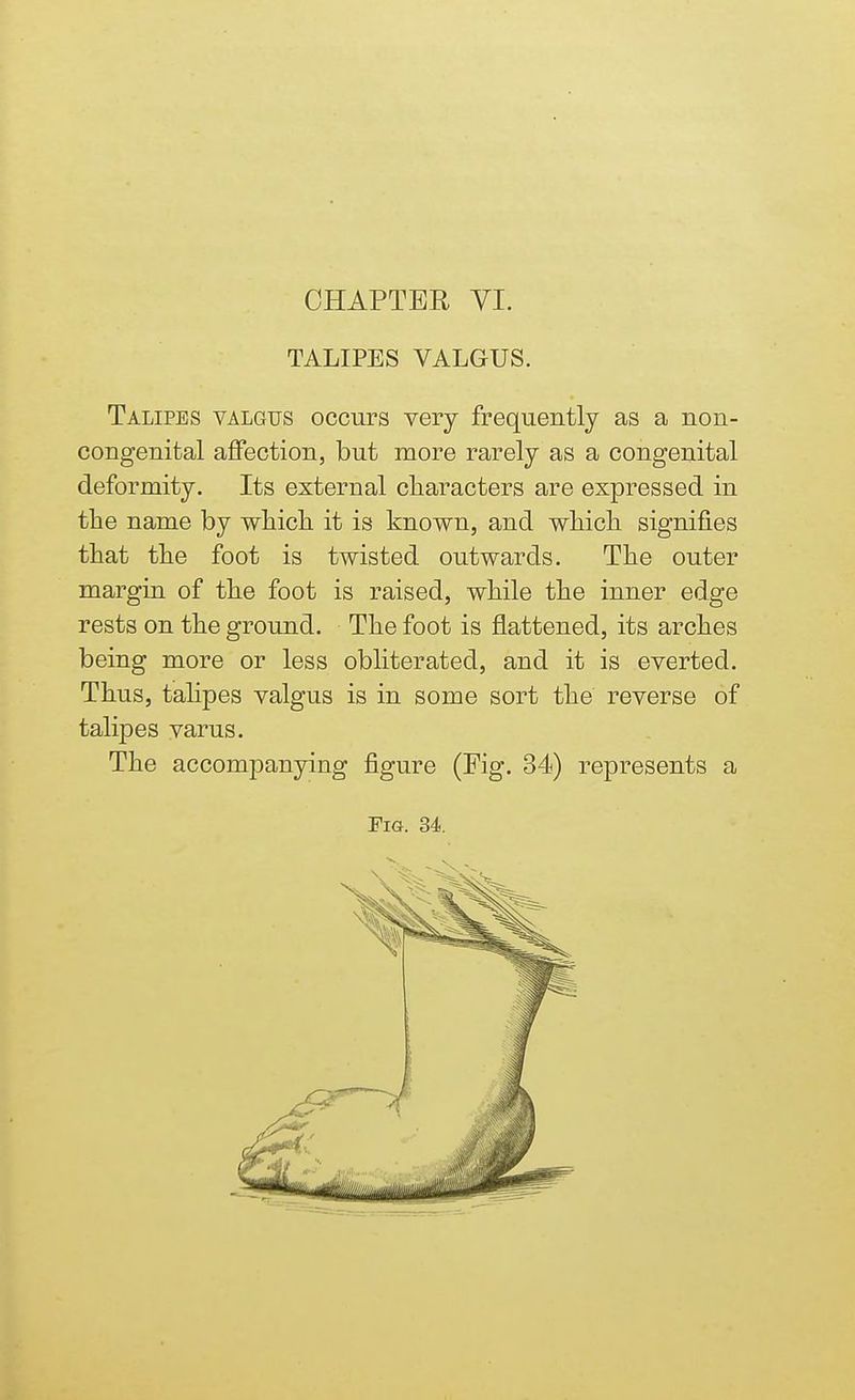 CHAPTER VI. TALIPES VALGUS. Talipes valgus occurs very frequently as a non- congenital affection, but more rarely as a congenital deformity. Its external characters are expressed in the name by which it is known, and which signifies that the foot is twisted outwards. The outer margin of the foot is raised, while the inner edge rests on the ground. The foot is flattened, its arches being more or less obliterated, and it is everted. Thus, talipes valgus is in some sort the reverse of talipes varus. The accompanying figure (Fig. 34) represents a Fig. 34.