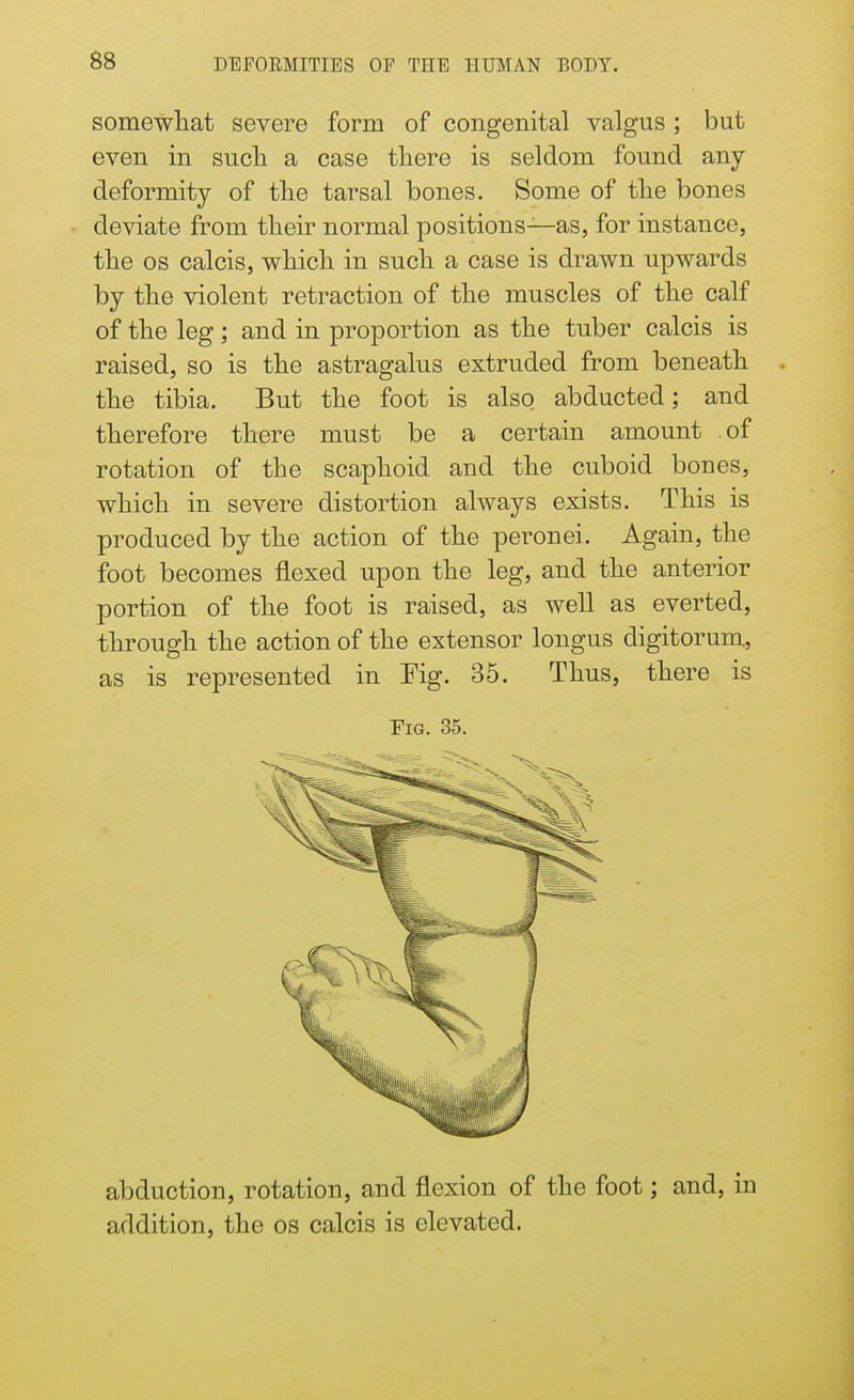 somewhat severe form of congenital valgus; but even in such a case there is seldom found any deformity of the tarsal bones. Some of the bones deviate from their normal positions—as, for instance, the os calcis, which in such a case is drawn upwards by the violent retraction of the muscles of the calf of the leg; and in proportion as the tuber calcis is raised, so is the astragalus extruded from beneath the tibia. But the foot is also abducted; and therefore there must be a certain amount of rotation of the scaphoid and the cuboid boues, which in severe distortion always exists. This is produced by the action of the peronei. Again, the foot becomes flexed upon the leg, and the anterior portion of the foot is raised, as well as everted, through the action of the extensor longus digitorum, as is represented in Fig. 35. Thus, there is Fig. 35. abduction, rotation, and flexion of the foot; and, in addition, the os calcis is elevated.