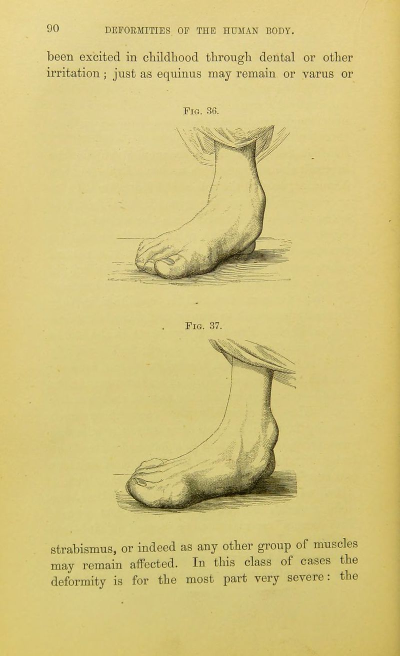 been excited in childhood through dental or other irritation ; just as equinus may remain or varus or Fig. 36. strabismus, or indeed as any other group of muscles may remain affected. In this class of cases the deformity is for the most part very severe: the
