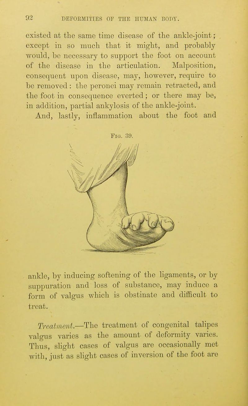 existed at the same time disease of the ankle-joint; except in so much that it might, and probably would, be necessary to support the foot on account of the disease in the articulation. Malposition, consequent upon disease, may, however, require to be removed: the peronei may remain retracted, and the foot in consequence everted; or there may be, in addition, partial ankylosis of the ankle-joint. And, lastly, inflammation about the foot aud Fig. 39. ankle, by inducing softening of the ligaments, or by suppuration and loss of substance, may induce a form of valgus which is obstinate and difficult to treat. Treatment.—The treatment of congenital talipes valgus varies as the amount of deformity varies. Thus, slight cases of valgus are occasionally met with, just as slight cases of inversion of the foot are