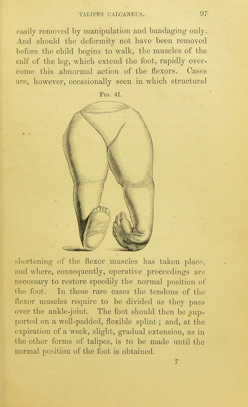easily removed by manipulation and bandaging only. And should the deformity not have been removed before the child begins to walk, the muscles of the calf of the leg, which extend the foot, rapidly over- come this abnormal action of the flexors. Cases are, however, occasionally seen in which structural Fig. 41. shortening of the flexor muscles has taken place, and where, consequently, operative proceedings are necessary to restore speedily the normal position of the foot. In these rare cases the tendons of the flexor muscles require to be divided as they pass over the ankle-joint. The foot should then be ^up- ported on a well-padded, flexible splint; and, at the expiration of a week, slight, gradual extension, as in the other forms of talipes, is to be made until the normal position of the foot is obtained. 7