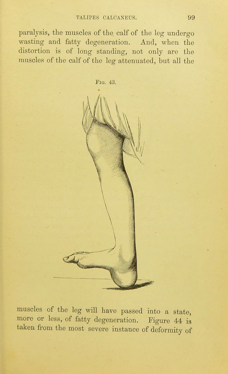paralysis, the muscles of the calf of the leg undergo wasting and fatty degeneration. And, when the distortion is of long standing, not only are the muscles of the calf of the leg attenuated, but all the Fig. 43. muscles of the leg will have passed into a state, more or less, of fatty degeneration. Figure 44 is taken from the most severe instance of deformity of