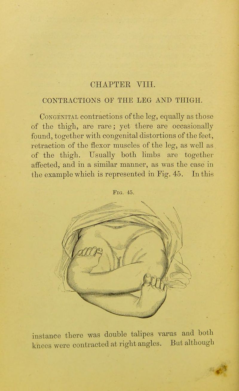 CHAPTER VIII. CONTRACTIONS OF THE LEG AND THIGH. Congenital contractions of the leg, equally as those of the thigh, are rare; yet there are occasionally found, together with congenital distortions of the feet, retraction of the flexor muscles of the leg, as well as of the thigh. Usually both limbs are together affected, and in a similar manner, as was the case in the example which is represented in Fig. 45. In this Pig. 45. instance there was double talipes varus and both knees were contracted at right angles. But although