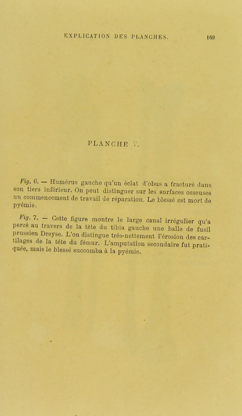PLANCHE Fig. 6. — Humérus gauche qu'un éclat d'obus a fracturé dans son tiers inférieur. On peut distinguer sur les surfaces osseuses un commencement de travail de réparation. Le Wessé est mort de pyémie. Fig. 7. - Cette figure montre le large canal irrégulier qu'a percé au travers de la têle du tibia gauche une balle de fusil prussien Dreyse. L'on distingue très-nettement l'érosion des car- tilages de la tete du fémur. L'amputation secondaire fut prati- quee, mais le blessé succomba à la pyémie.