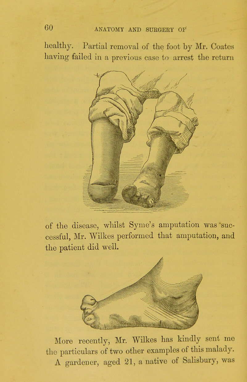 healthy. Partial removal of the foot by Mr. Coates having failed in a previous case to arrest the return of the disease, whilst Syme's amputation was suc- cessful, Mr. Wilkes performed that amputation, and the patient did well. More recently, Mr. Wilkes has kindly sent me the particulars of two other examples of this malady. A gardener, aged 21, a native of Salisbury, was