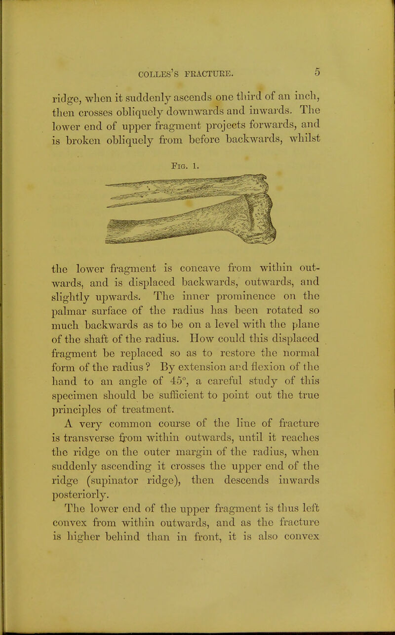 ridge, when it suddenly ascends one third of an inch, then crosses obliquely downwards and inwards. The lower end of upper fragment projects forwards, and is broken obliquely from before backwards, whilst Fig. 1. the lower fragment is concave from within out- wards, and is displaced backwards, outwards, and slightly upwards. The inner prominence on the palmar surface of the radius has been rotated so much backwards as to be on a level with the plane of the shaft of the radius. How could this displaced fragment be replaced so as to restore the normal form of the radius ? By extension and flexion of the hand to an angle of 45°, a careful study of this specimen should be sufficient to point out the true principles of treatment. A very common course of the line of fracture is transverse from within outwards, until it reaches the ridge on the outer margin of the radius, when suddenly ascending it crosses the upper end of the ridge (supinator ridge), then descends inwards posteriorly. The lower end of the upper fragment is thus left convex from within outwards, and as the fracture is higher behind than in front, it is also convex