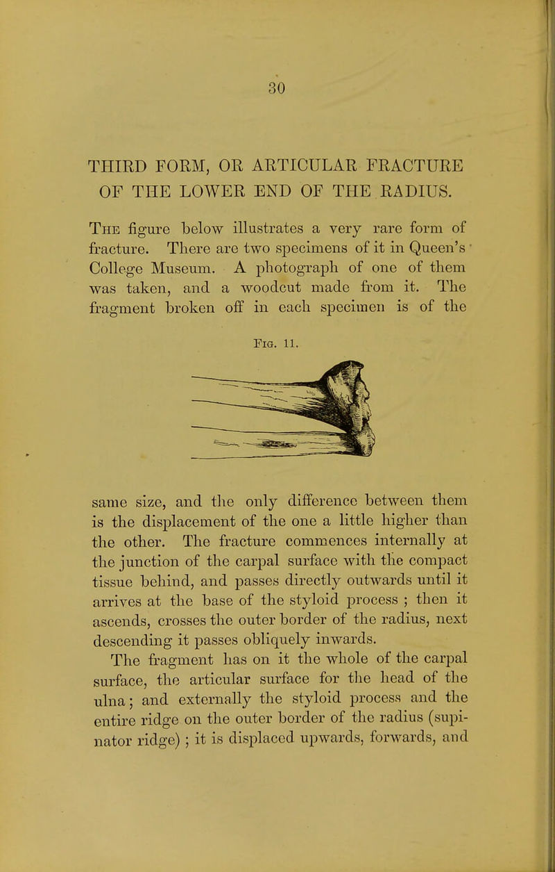 THIRD FORM, OR ARTICULAR FRACTURE OF THE LOWER END OF THE RADIUS. The figure below illustrates a very rare form of fracture. There are two specimens of it in Queen's College Museum. A photograph of one of them was taken, and a woodcut made from it. The fragment broken off in each specimen is of the Fig. 11. same size, and the only difference between them is the displacement of the one a little higher than the other. The fracture commences internally at the junction of the carpal surface with the compact tissue behind, and passes directly outwards until it arrives at the base of the styloid process ; then it ascends, crosses the outer border of the radius, next descending it passes obliquely inwards. The fragment has on it the whole of the carpal surface, the articular surface for the head of the ulna; and externally the styloid process and the entire ridge on the outer border of the radius (supi- nator ridge) ; it is displaced upwards, forwards, and