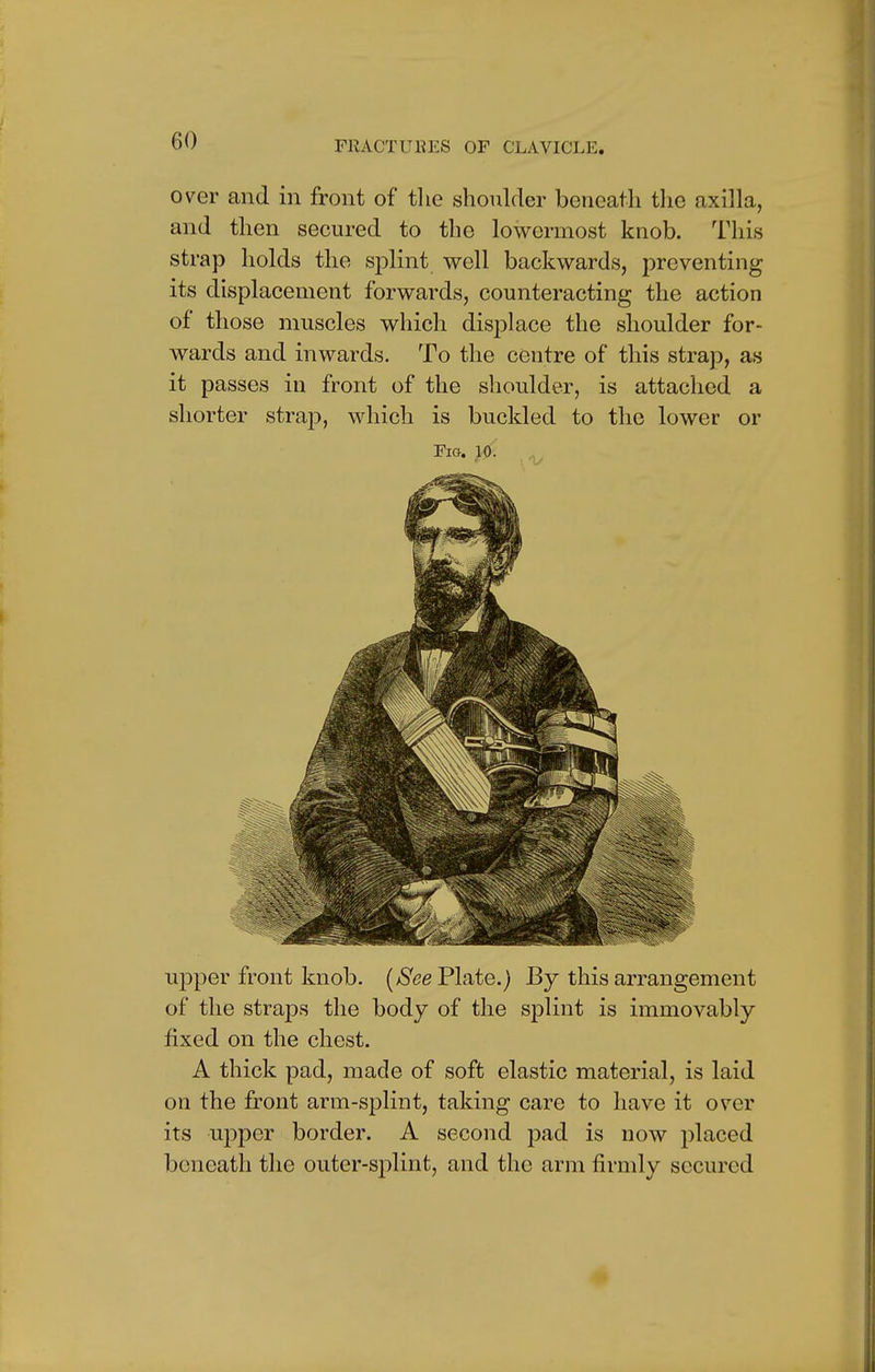 over and in front of the shoulder beneath the axilla, and then secured to the lowermost knob. This strap holds the splint well backwards, preventing its displacement forwards, counteracting the action of those muscles which displace the shoulder for- wards and inwards. To the centre of this strap, as it passes in front of the shoulder, is attached a shorter strap, which is buckled to the lower or Fig. 10. upper front knob. [See Plate.) By this arrangement of the straps the body of the splint is immovably fixed on the chest. A thick pad, made of soft elastic material, is laid on the front arm-splint, taking care to have it over its upper border. A second pad is now placed beneath the outer-splint, and the arm firmly secured