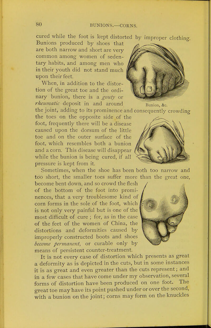 BUNIONS.—CORNS. cured while the foot is kept distorted by improper clothi Bunions produced by shoes that are both narrow and short are veiy common among women of seden- tary habits, and among men who in their youth did not stand much upon their feet. When, in addition to the distor- tion of the great toe and the ordi- nary bunion, there is a gouty or rheitmatic deposit in and around the joint, adding to its prominence and consequently crowding the toes on the opposite side of the foot, frequently there will be a disease caused upon the dorsum of the little toe and on the outer surface of the foot, which resembles both a bunion and a corn. This disease will disappear while the bunion is being cured, if all pressure is kept from it. Sometimes, when the shoe has been both too narrow and too short, the smaller toes suffer more than the great one, become bent down, and so crowd the flesh of the bottom of the foot into promi- nences, that a very troublesome kind of corn forms in the sole of the foot, which is not only very painful but is one of the most difficult of cure ; for, as in the case of the feet of the women of China, the distortions and deformities caused by improperly constructed boots and shoes become permanent, or curable only by means of persistent counter-treatment. It is not every case of distortion which presents as great a deformity as is depicted in the cuts, but in some instances it is as great and even greater than the cuts represent; and in a few cases that have come under my observation, several forms of distortion have been produced on one foot. The great toe may have its point pushed under or over the second, with a bunion on the joint; corns may form on the knuckles Bunion, &c.