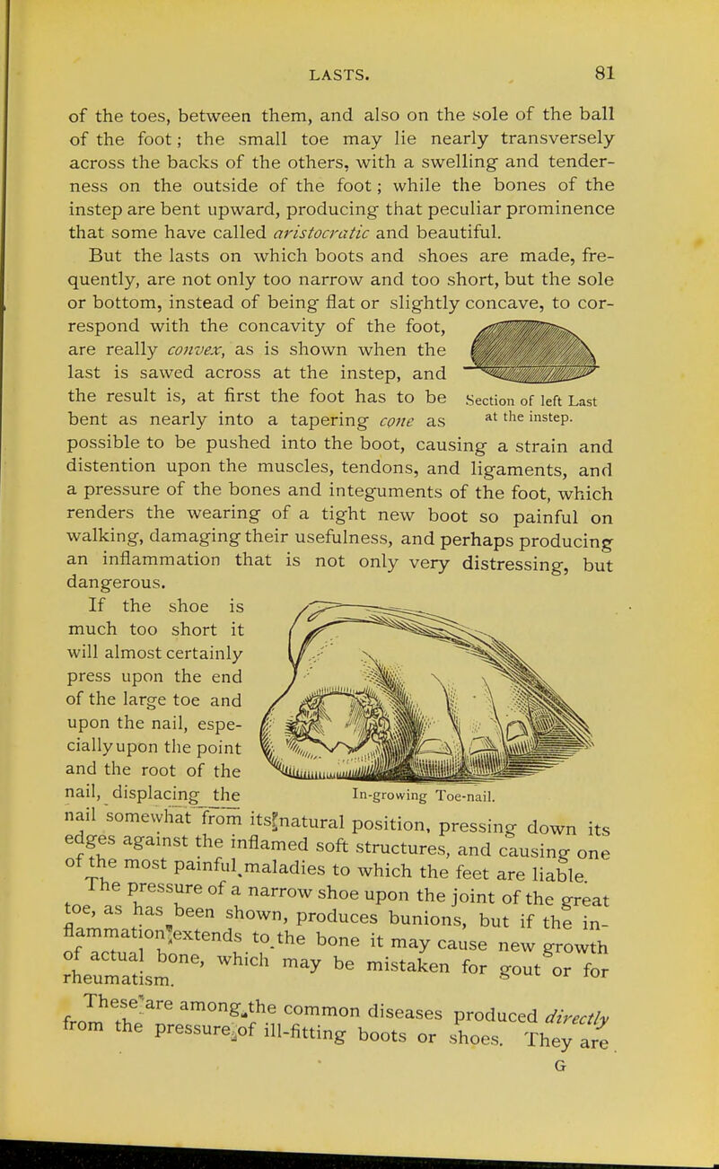 Section of left Last at the instep. of the toes, between them, and also on the sole of the ball of the foot; the small toe may lie nearly transversely across the backs of the others, with a swelling- and tender- ness on the outside of the foot; while the bones of the instep are bent upward, producing that peculiar prominence that some have called aristocratic and beautiful. But the lasts on which boots and shoes are made, fre- quently, are not only too narrow and too short, but the sole or bottom, instead of being flat or slightly concave, to cor- respond with the concavity of the foot, are really convex, as is shown when the last is sawed across at the instep, and the result is, at first the foot has to be bent as nearly into a tapering cone as possible to be pushed into the boot, causing a strain and distention upon the muscles, tendons, and ligaments, and a pressure of the bones and integuments of the foot, which renders the wearing of a tight new boot so painful on walking, damaging their usefulness, and perhaps producing an inflammation that is not only very distressing, but dangerous. If the shoe is much too short it will almost certainly press upon the end of the large toe and upon the nail, espe- ciallyupon the point and the root of the nail, displacing the nail somewhat from ^natural position, pressing down its edges against the inflamed soft structures, and causing one of the most pamful maladies to which the feet are liable The pressure of a narrow shoe upon the joint of the great toe, as has been shown, produces bunions, but if the in- flammation^extends to the bone it may cause new growth lrat!sm°ne' WWCh ^y bG ** *>* « 2 These'are among-the common diseases produced directly from the pressure^ ill-fitting boots or shoes. They are G