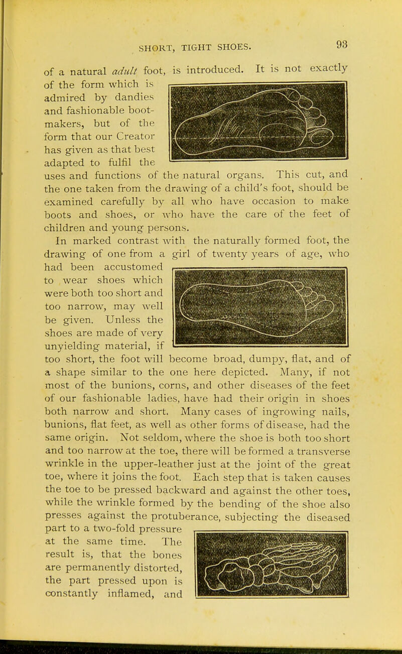 SHORT, TIGHT SHOES. of a natural adult foot, is introduced. It is not exactly of the form which is admired by dandies and fashionable boot- makers, but of the form that our Creator has given as that best adapted to fulfil the uses and functions of the natural organs. This cut, and the one taken from the drawing of a child's foot, should be examined carefully by all who have occasion to make boots and shoes, or who have the care of the feet of children and young persons. In marked contrast with the naturally formed foot, the drawing of one from a girl of twenty years of age, who had been accustomed to wear shoes which were both too short and too narrow, may well be given. Unless the shoes are made of very unyielding material, if too short, the foot will become broad, dumpy, flat, and of a shape similar to the one here depicted. Many, if not most of the bunions, corns, and other diseases of the feet of our fashionable ladies, have had their origin in shoes both narrow and short. Many cases of ingrowing nails, bunions, flat feet, as we'll as other forms of disease, had the same origin. Not seldom, where the shoe is both too short and too narrow at the toe, there will be formed a transverse wrinkle in the upper-leather just at the joint of the great toe, where it joins the foot. Each step that is taken causes the toe to be pressed backward and against the other toes, while the wrinkle formed by the bending of the shoe also presses against the protuberance, subjecting the diseased part to a two-fold pressure at the same time. The result is, that the bones are permanently distorted, the part pressed upon is constantly inflamed, and