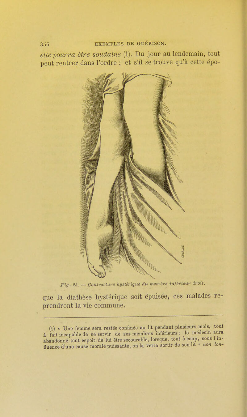 3uG EXEMPLES DE GUÉRISON. elle pourra être soudaine (1). Du jour au lendemain, tout peut rentrer dans l'ordre ; et s'il se trouve qu'à cette épo- Fig. S3. — Contracture hystérique du membre in/érieur droit. que la diatlièse hystérique soit épuisée, ces malades re- prendront la vie commune. (l) • Une femme sera restée confinée au lit pendant plusieurs mois, tout à fait incapable de se servir de ses membres inférieurs; le médecin aura abandonné tout espoir de lui être secourable, lorsque, tout à coup, sous l'in- lluence d'une cause morale puissante, on la verra sortir de son lit • non Ion-