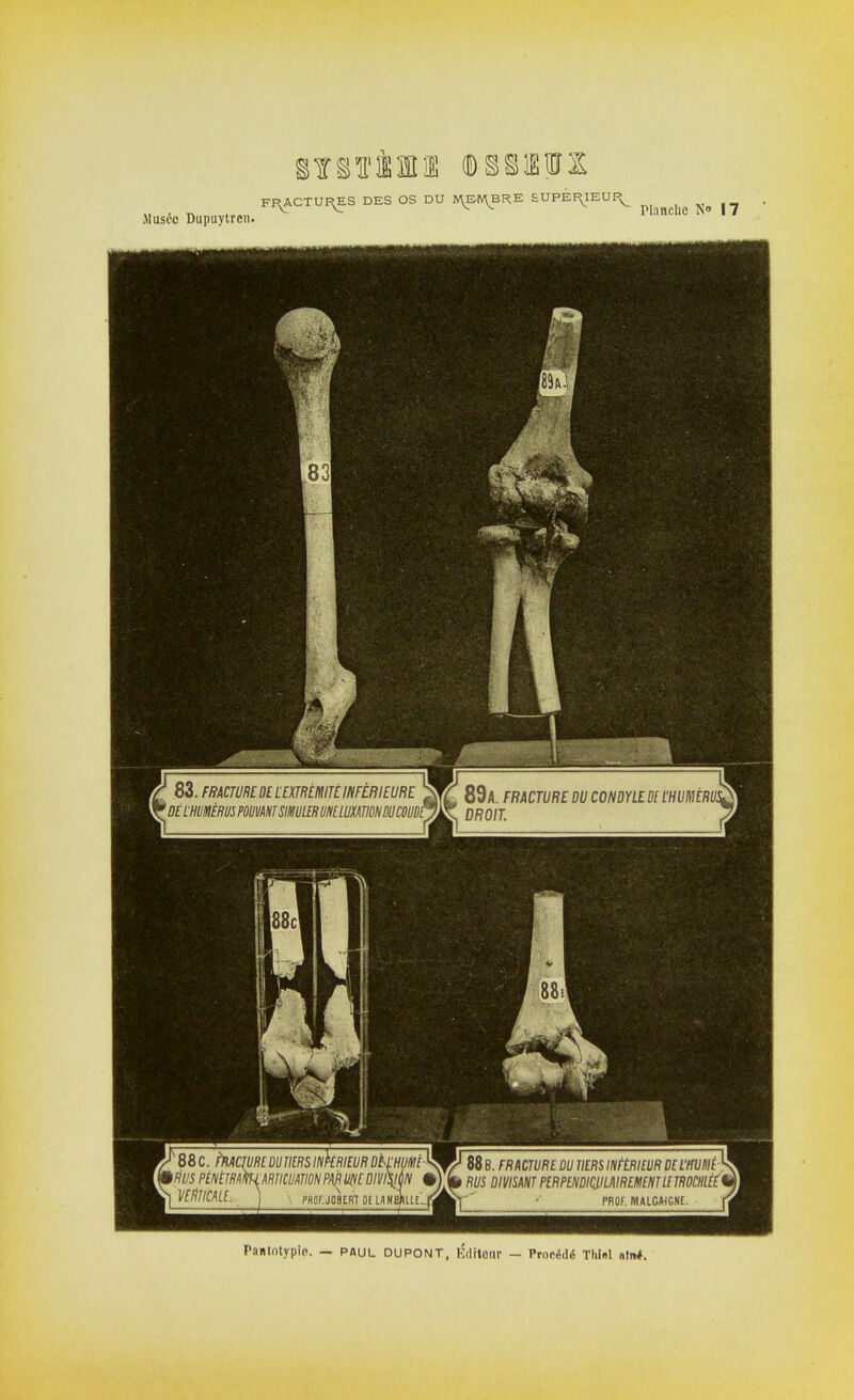 Musée Dupuytren, F^ACTUF^S DES OS DU J^BRE SUPEEyEUI^ ^ ^ Pantotypie. — PAUL DUPONT, édîtOIN — Procédé Thiel atn*.