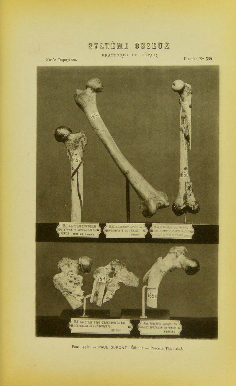 Musée Dupuytren. Tlanche No 25 ' Pantotypio, — PAUL DUPONT, BditOUr — Procédé Thiol nlné.