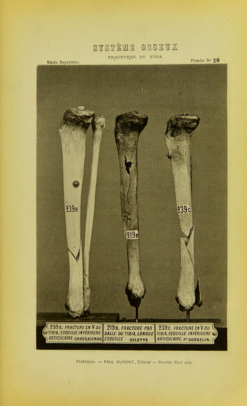 FF^ACTUI^ES DU TIBIA 239 b. fracture en V du U^TIBIA, ESQUILLE INFÉRIEURE L ARTICULAIRE. CHASSAICNAG 219 B. FRACTURE PAR BALLE DU TIBIA, LONGUE ESQUILLE GILETTE 239C. FRACTURE ENVDU ^| TIBIA, ESQUILLE INFÉRIEURE «H ARTICULAIRE. PrCOSSELIN. [flf