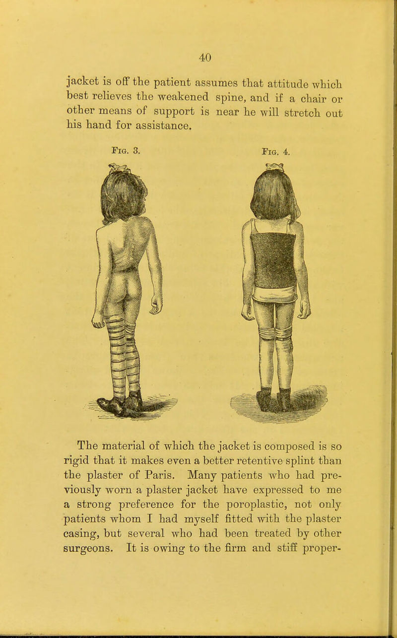 jacket is off the patient assumes tliat attitude which best relieves the weakened spine, and if a chair or other means of support is near he will stretch out his hand for assistance. Fig. 3. Tig. 4. The material of which the jacket is composed is so rigid that it makes even a better retentive splint than the plaster of Paris. Many patients who had pre- viously worn a plaster jacket have expressed to me a strong preference for the poroplastic, not only patients whom I had myself fitted with the plaster casing, but several who had been treated by other surgeons. It is owing to the firm and stiff proper-