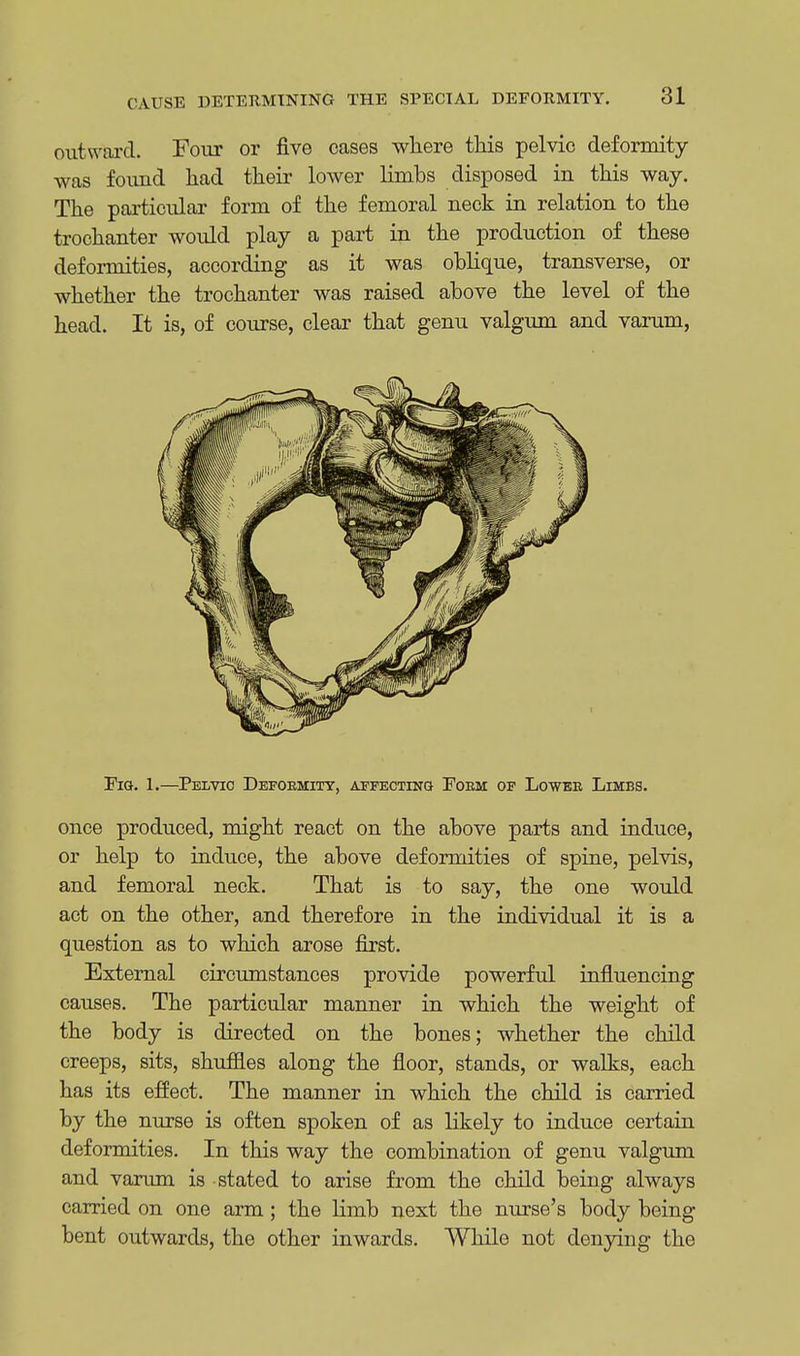 outward. Four or five cases where this pelvic deformity was found had their lower limbs disposed in this way. The particular form of the femoral neck in relation to the trochanter would play a part in the production of these deformities, according as it was oblique, transverse, or whether the trochanter was raised above the level of the head. It is, of course, clear that genu valgum and varum, Fig. 1.—Pelvic Deformity, affecting Fokm of Lowee Limbs. once produced, might react on the above parts and induce, or help to induce, the above deformities of spine, pelvis, and femoral neck. That is to say, the one would act on the other, and therefore in the individual it is a question as to which arose first. External circumstances provide powerful influencing causes. The particular manner in which the weight of the body is directed on the bones; whether the child creeps, sits, shuffles along the floor, stands, or walks, each has its effect. The manner in which the child is carried by the nurse is often spoken of as likely to induce certain deformities. In this way the combination of genu valgum and varum is stated to arise from the child being always carried on one arm; the limb next the nurse's body being bent outwards, the other inwards. While not denying the