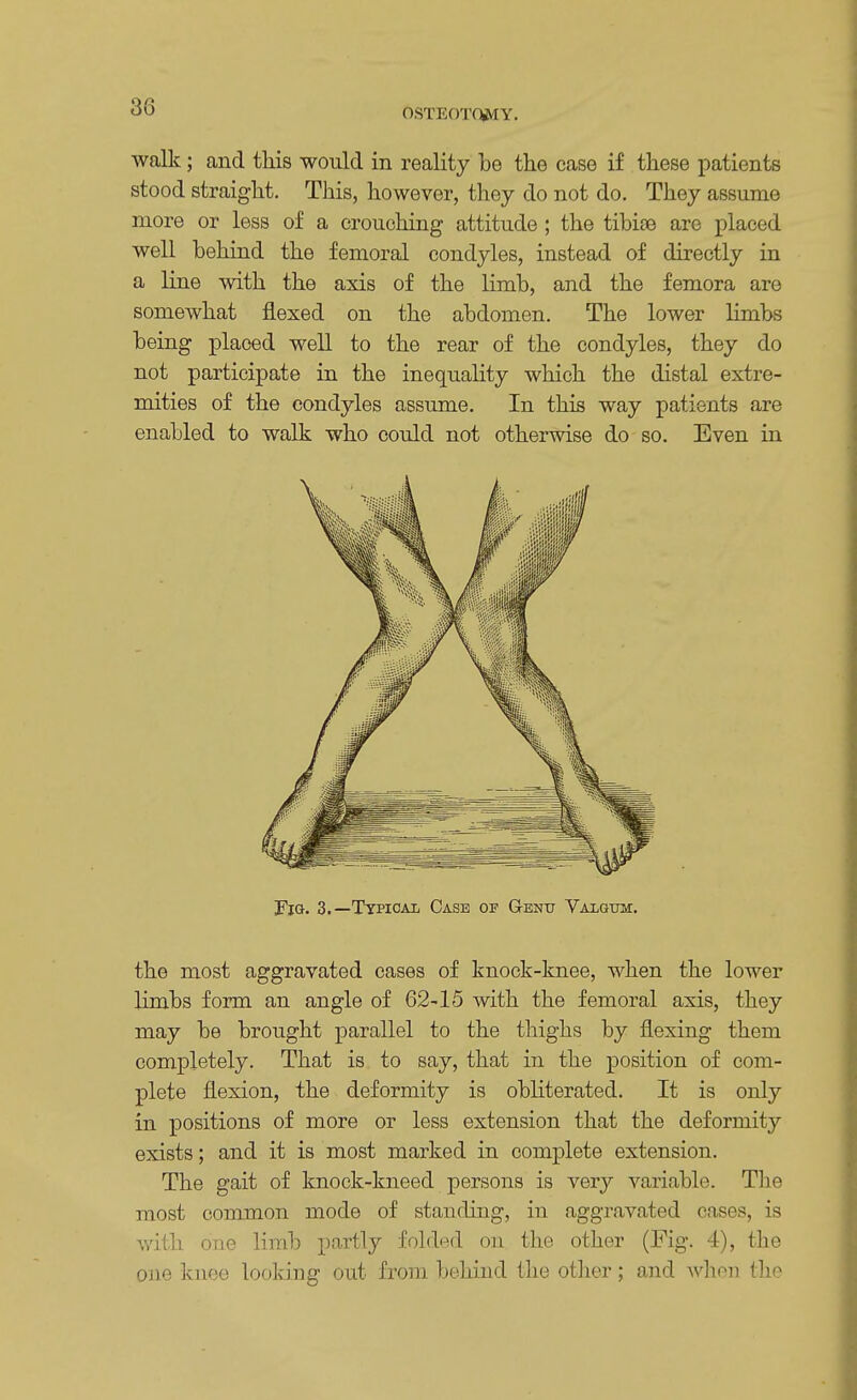 OSTEOTOMY. walk; and this would in reality be the case if these patients stood straight. This, however, they do not do. They assume more or less of a crouching attitude ; the tibiae are placed well behind the femoral condyles, instead of directly in a line with the axis of the limb, and the femora are somewhat flexed on the abdomen. The lower limbs being placed well to the rear of the condyles, they do not participate in the inequality which the distal extre- mities of the condyles assume. In this way patients are enabled to walk who could not otherwise do so. Even in Tig. 3.—Typical Case of Genu Valgum. the most aggravated cases of knock-knee, when the lower limbs form an angle of 62-15 with the femoral axis, they may be brought parallel to the thighs by flexing them completely. That is to say, that in the position of com- plete flexion, the deformity is obliterated. It is only in positions of more or less extension that the deformity exists; and it is most marked in complete extension. The gait of knock-kneed persons is very variable. The most common mode of standing, in aggravated cases, is with one limb partly folded on the other (Fig. 4), the one knee looking out from behind the other; and when the