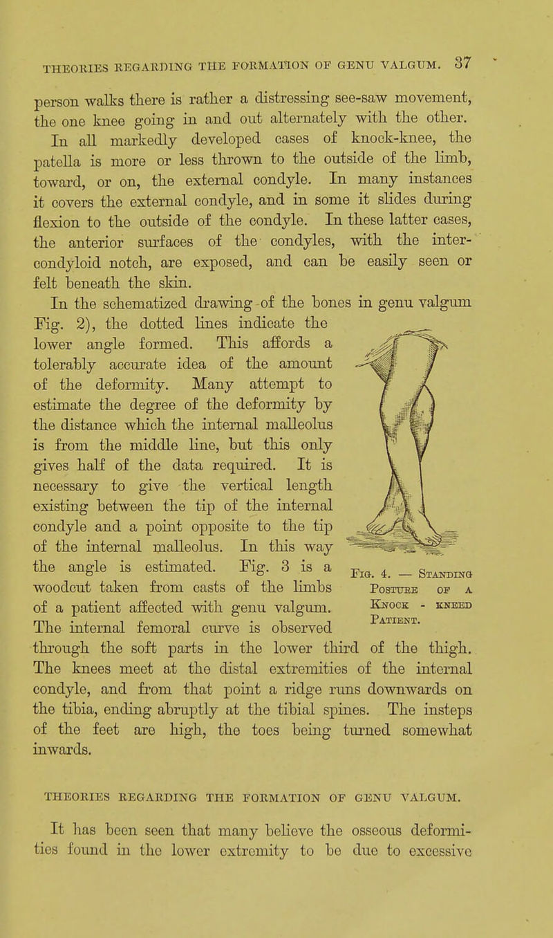 person walks there is rather a distressing see-saw movement, the one knee going in and out alternately with the other. In all markedly developed cases of knock-knee, the patella is more or less thrown to the outside of the limb, toward, or on, the external condyle. In many instances it covers the external condyle, and in some it slides during flexion to the outside of the condyle. In these latter cases, the anterior surfaces of the condyles, with the inter- condyloid notch, are exposed, and can be easily seen or felt beneath the skin. In the schematized drawing-of the bones in genu valgum Fig. 2), the dotted lines indicate the lower angle formed. This affords a tolerably accurate idea of the amount of the deformity. Many attempt to estimate the degree of the deformity by the distance which the internal malleolus is from the middle line, but this only gives half of the data required. It is necessary to give the vertical length existing between the tip of the internal condyle and a point opposite to the tip of the internal malleolus. In this way the angle is estimated. Fig. 3 is a woodcut taken from casts of the limbs of a patient affected with genu valgum. The internal femoral curve is observed through the soft parts in the lower third of the thigh. The knees meet at the distal extremities of the internal condyle, and from that point a ridge runs downwards on the tibia, ending abruptly at the tibial sj)ines. The insteps of the feet are high, the toes being turned somewhat inwards. THEORIES REGARDING THE FORMATION OF GENU VALGUM. It has been seen that many believe the osseous deformi- ties found in the lower extremity to be duo to excessivo Fig. 4. — Standing postttee of a Knock - kneed Patient.