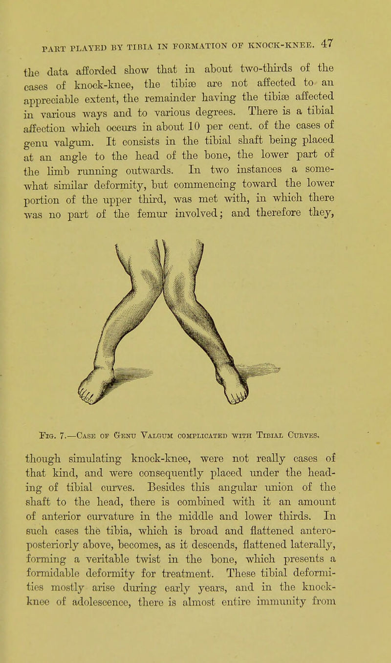 the data afforded show that in about two-thirds of the cases of knock-knee, the tibiae are not affected to an appreciable extent, the remainder having the tibise affected in various ways and to various degrees. There is a tibial affection which occurs in about 10 per cent, of the cases of genu valgum. It consists in the tibial shaft being placed at an angle to the head of the bone, the lower part of the limb running outwards. In two instances a some- what similar deformity, but commencing toward the lower portion of the upper third, was met with, in which there was no part of the femur involved; and therefore they, Fig. 7.—Case op Genu Valgum complicated with Tibial Curves. though simulating knock-knee, were not really cases of that kind, and were consequently placed under the head- ing of tibial curves. Besides this angular union of the shaft to the head, there is combined with it an amount of anterior curvature in the middle and lower thirds. In such cases the tibia, which is broad and flattened antero- posteriorly above, becomes, as it descends, flattened laterally, forming a veritable twist in the bone, which presents a formidable deformity for treatment. These tibial deformi- ties mostly arise during early years, and in the knock- knee of adolescence, there is almost entire immunity from