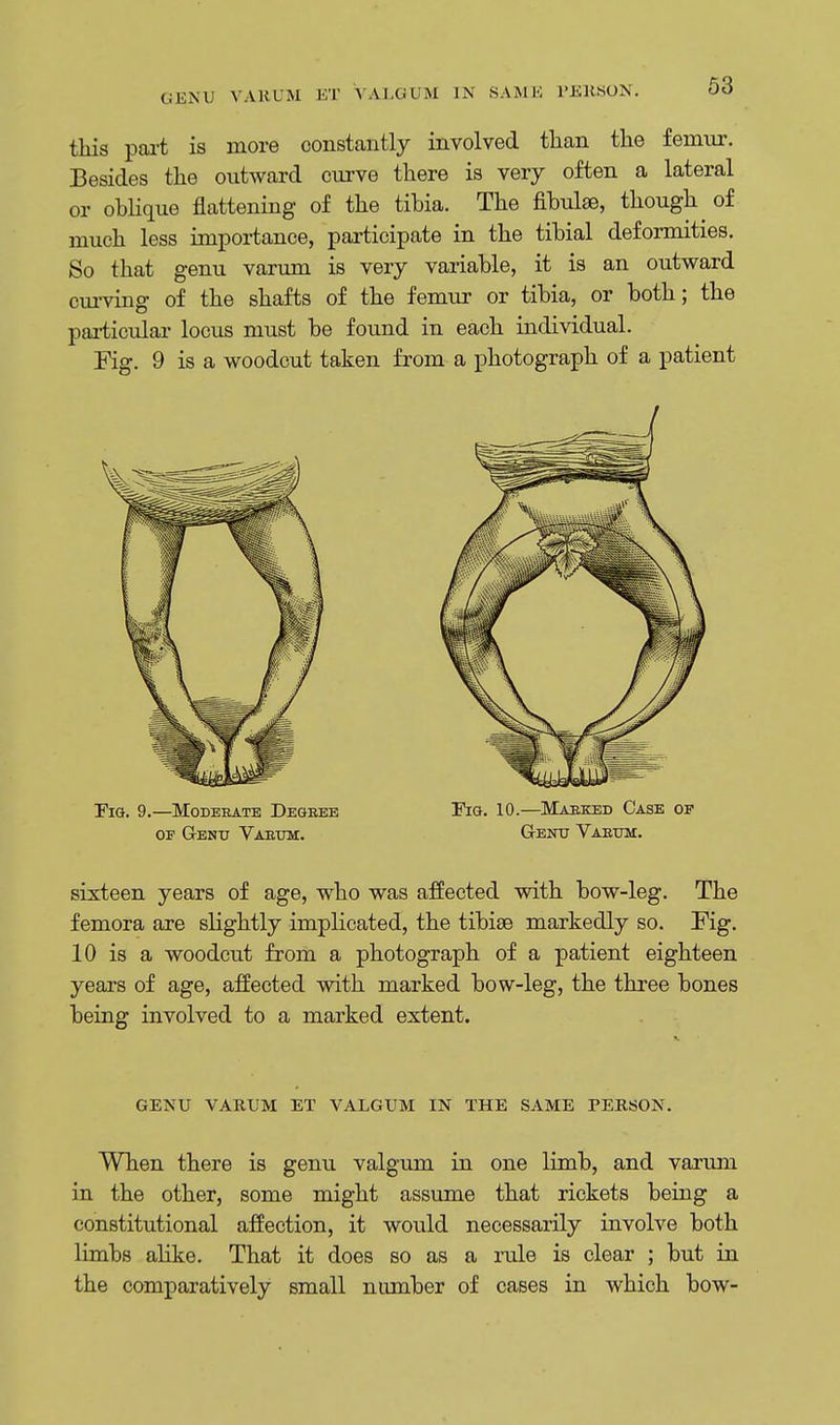 GENU VARUM BT VALGUM IN SAME PERSON. this part is more constantly involved than the femur. Besides the outward curve there is very often a lateral or oblique flattening of the tibia. The fibulae, though^ of much less importance, participate in the tibial deformities. So that genu varum is very variable, it is an outward curving of the shafts of the femur or tibia, or both; the particular locus must be found in each individual. Fig. 9 is a woodcut taken from a photograph of a patient Fig. 9.—Moderate Degree Fig. 10.—Marked Case op of Genu Varum. Genu Varum. sixteen years of age, who was affected with bow-leg. The femora are slightly implicated, the tibiae markedly so. Fig. 10 is a woodcut from a photograph of a patient eighteen years of age, affected with marked bow-leg, the three bones being involved to a marked extent. GENU VARUM ET VALGUM IN THE SAME PERSON. When there is genu valgum in one limb, and varum in the other, some might assume that rickets being a constitutional affection, it would necessarily involve both limbs alike. That it does so as a rule is clear ; but in the comparatively small number of cases in which bow-