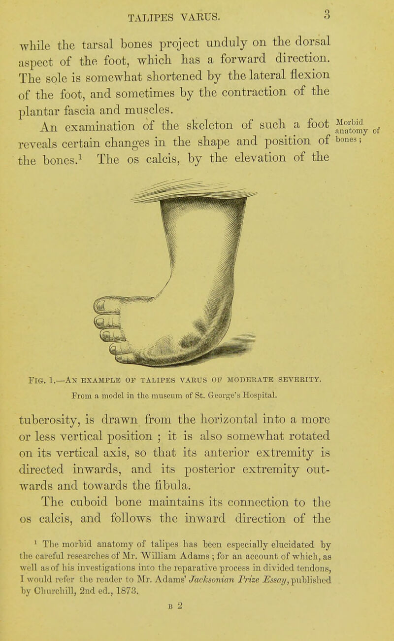 while the tarsal bones project unduly on the dorsal aspect of the foot, which has a forward direction. The sole is somewhat shortened by the lateral flexion of the foot, and sometimes by the contraction of the plantar fascia and muscles. An examination of the skeleton of such a foot reveals certain changes in the shape and position of the bones.^ The os calcis, by the elevation of the Fig. 1.—An example op talipes vakus of modeeate seveeity. From a model in the museum of St. Geoi'se's Hospital. tuberosity, is drawn from the horizontal into a more or less vertical position ; it is also somewhat rotated on its vertical axis, so that its anterior extremity is directed inwards, and its posterior extremity out- wards and towards the fibula. The cuboid bone maintains its connection to the 08 calcis, and follows the inward direction of the 1 The morlDid anatomy of talipes has been especially elucidated by tlie careful researches of Mr. William Adams ; for an account of which, as well as of his investigations into the reparative process in divided tendons, I would refer the reader to Mr. Adams' JacJcsonian Frize -Etw?/, piiblished by Churchill, 2nd cd., 1873. B 2