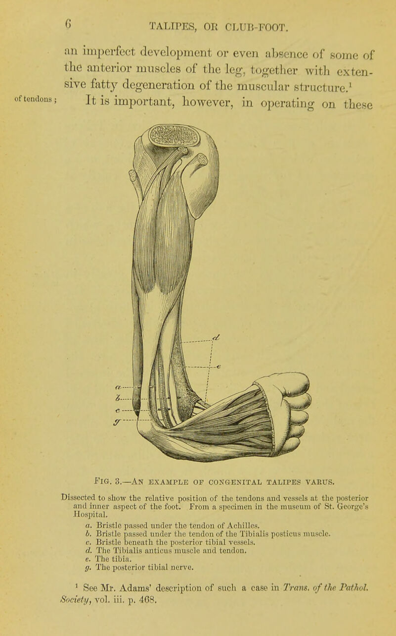 an imperfect development or even abBcnce of some of tlie jmterior muscles of the leg, together with exten- sive fatty degeneration of the muscular structure.^ It is important, however, in operating on these Fig. 3.—An example op congenital talipes varus. Dissected to show the relative position of the tendons and vessels at the posterior and inner aspect of the foot. From a specimen in the museum of St. George's Hospital. a. Bristle passed under the tendon of Achilles. b. Bristle passed under the tendon of the Tibialis posticus muscle. c. Bristle beneath the posterior tibial vessels. d. The Tibialis anticus muscle and tendon. e. The tibia. g. The posterior tibial nerve. ' See Mr. Adams' description of such a case in Trans, of the. Pathol Society, vol. iii. p. 408.