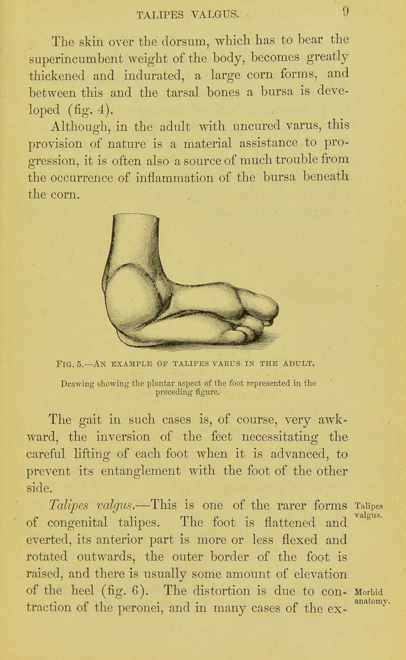 The skin over the dorsum, which has to bear the superincumbent weight of the body, becomes greatly thickened and indurated, a large corn forms, and between this and the tarsal bones a bursa is deve- loped (fig. 4). Although, in the adult with uncured varus, this provision of nature is a material assistance to pro- gression, it is often also a source of much trouble from the occurrence of inflammation of the bursa beneath the corn. Fig. 5.—An example of talipes varus in the adult. Drawing sliowing the plantar aspect of the foot represented in the preceding figure. The gait in such cases is, of course, very awk- ward, the inversion of tbe feet necessitating the careful lifting of each foot when it is advanced, to prevent its entanglement with the foot of the other side. Talipes valgus.—This is one of the rarer forms Talipes of congenital talipes. The foot is flattened and everted, its anterior part is more or less flexed and rotated outwards, the outer border of the foot is raised, and there is usually some amount of elevation of the heel (fig. 6). The distortion is due to con- Morbid , f. ,T . •, . „ , anatomy. traction oi the peronei, and m many cases of the ex-