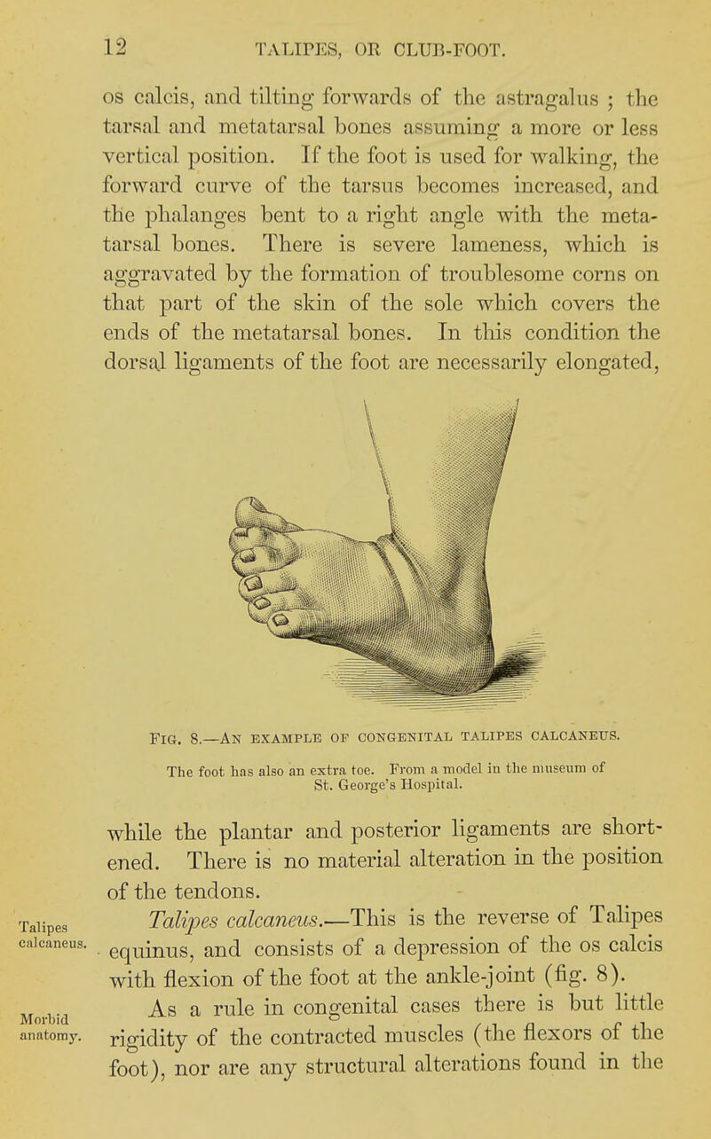 Talipes calcaneus. Morbid anatomy. OS calcis, and tilting forwards of the astragalus ; the tarsal and metatarsal bones assuming a more or less vertical position. If the foot is used for walking, the forward curve of the tarsus becomes increased, and the phalanges bent to a right angle with the meta- tarsal bones. There is severe lameness, which is aggravated by the formation of troublesome corns on that part of the skin of the sole which covers the ends of the metatarsal bones. In this condition the dorsal ligaments of the foot are necessarily elongated, Fig. 8.—An example op congenital talipes calcaneus. The foot lias also an extra toe. From a model in the mnsenm of St. George's Hospital. while the plantar and posterior ligaments are short- ened. There is no material alteration in the position of the tendons. Talipes calcaneus.^Thi^ is the reverse of Talipes equinus, and consists of a depression of the os calcis with flexion of the foot at the ankle-joint (fig. 8). As a rule in congenital cases there is but little rigidity of the contracted muscles (the flexors of the foot), nor are any structural alterations found in the